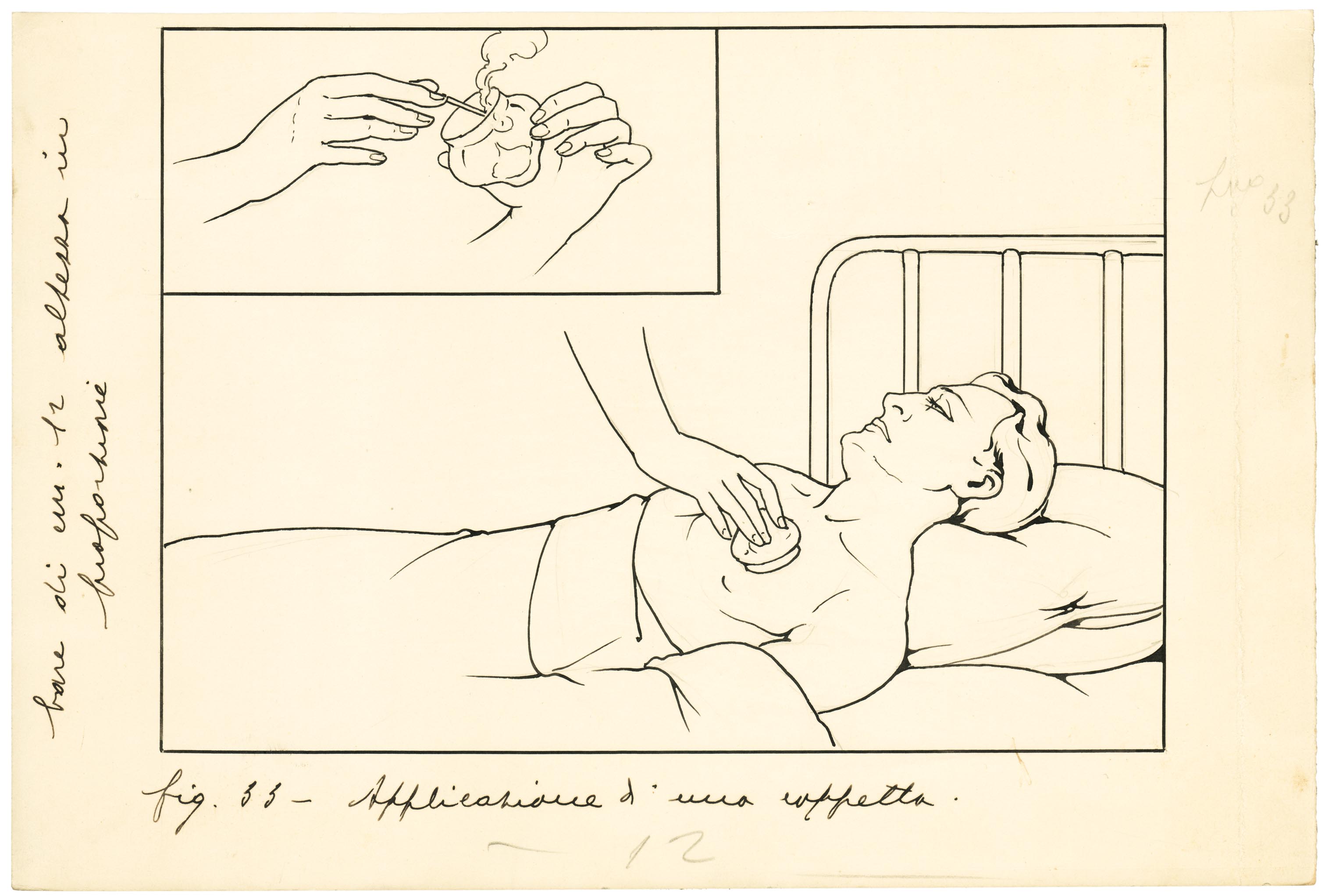 applicazione di una coppetta (disegno) di Anichini Ezio (secondo quarto sec. XX)