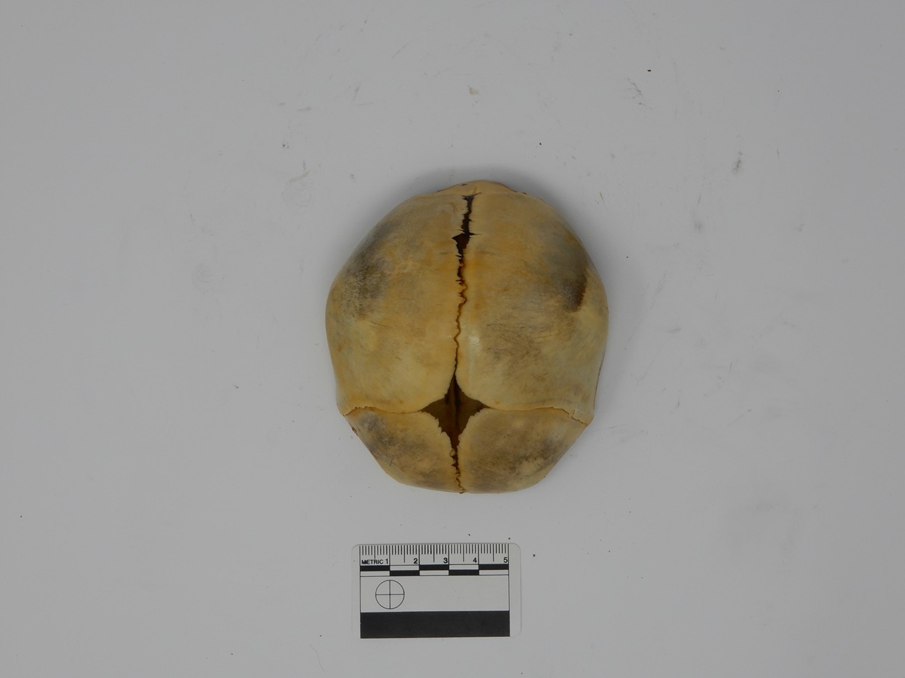 singolo reperto antropologico, reperto osseo (morfologia alterata per patologia) (XIX-XX)