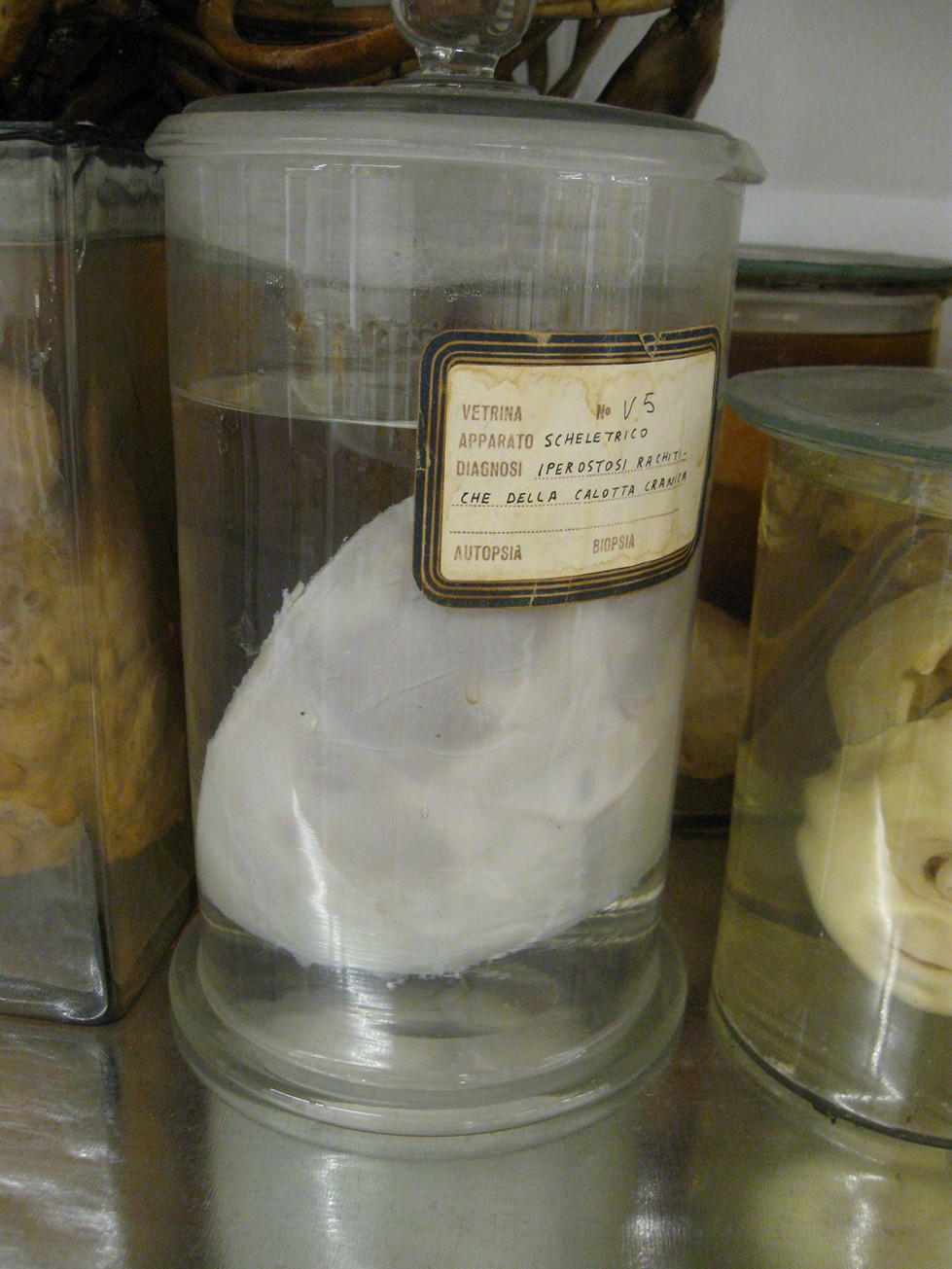 singolo reperto antropologico, reperto osseo (morfologia alterata per patologia) (XIX-XX)