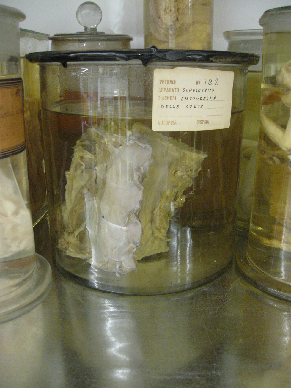 singolo reperto antropologico, reperto osseo (morfologia alterata per patologia) (XIX-XX)