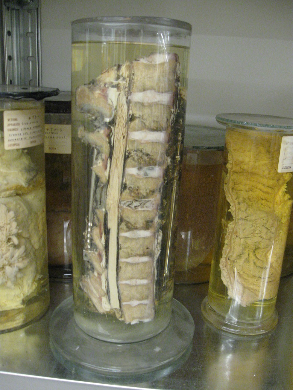 singolo reperto antropologico, reperto osseo (morfologia alterata per patologia) (XIX-XX)