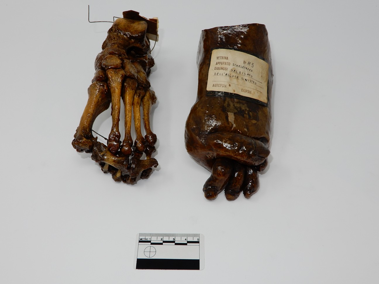 singolo reperto antropologico, reperto osseo (morfologia alterata per patologia) (XIX-XX)