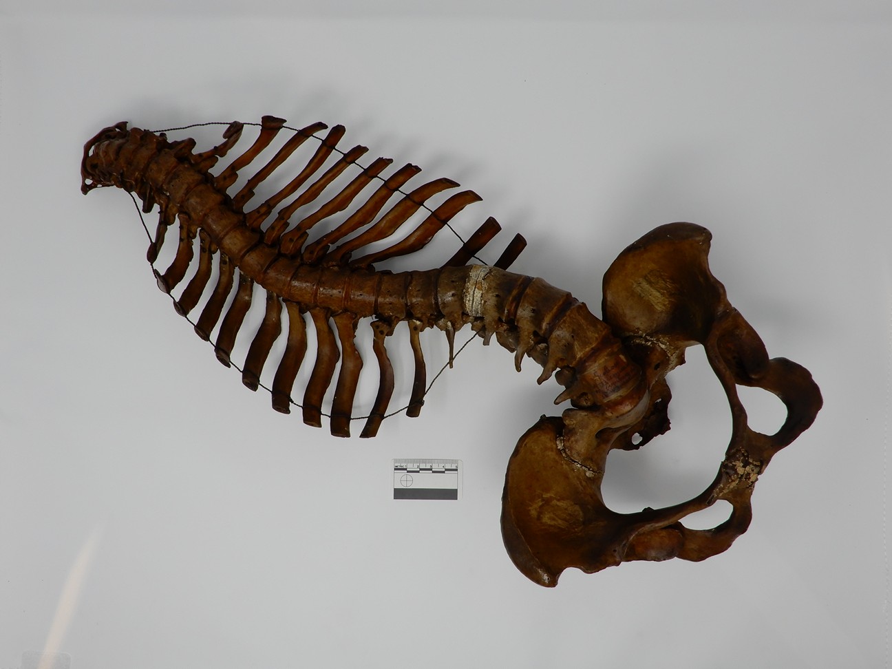 singolo reperto antropologico, reperto osseo (morfologia alterata per patologia) (XIX-XX)