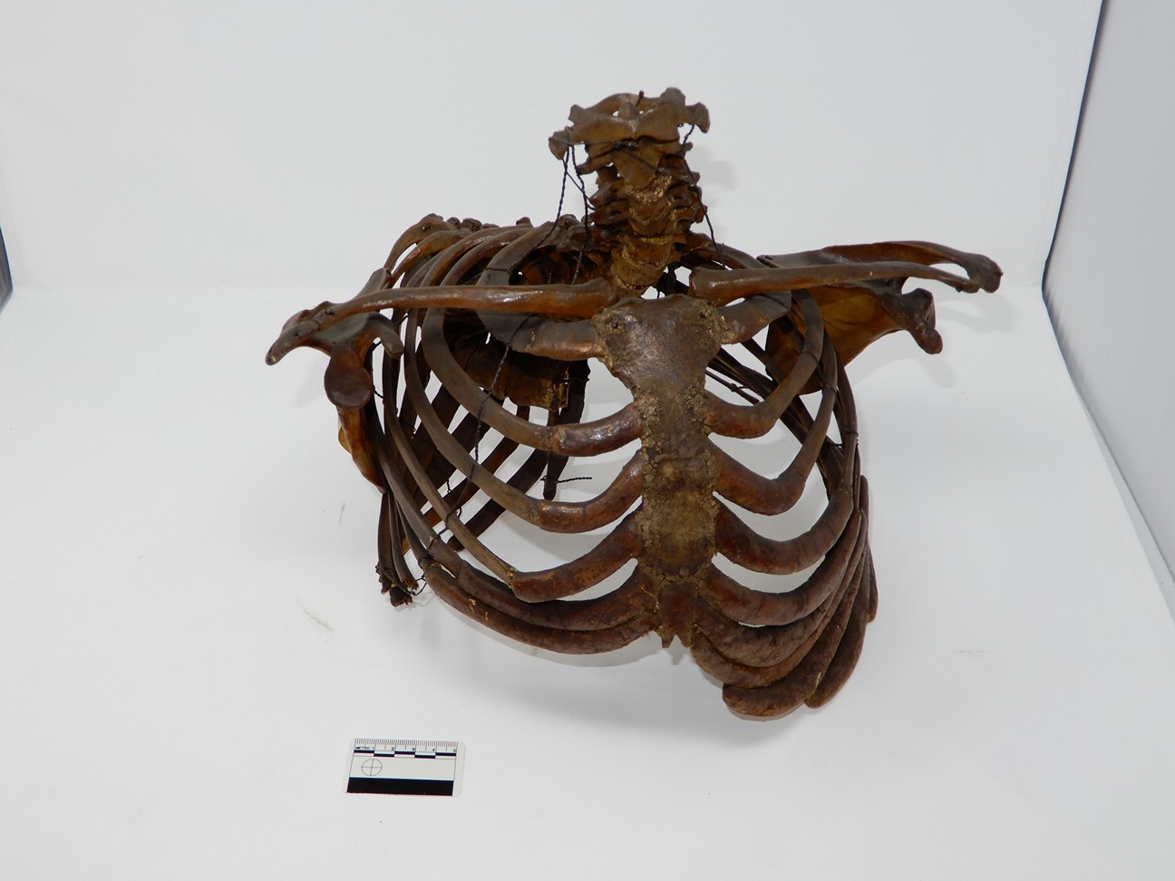 singolo reperto antropologico, reperto osseo (morfologia alterata per patologia) (XIX-XX)