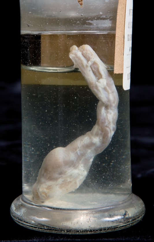 singolo reperto antropologico, preparato anatomico (morfologia alterata per patologia) (XIX-XX)