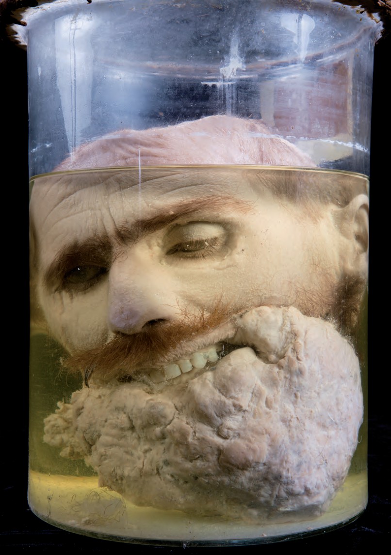 singolo reperto antropologico, preparato anatomico (morfologia alterata per patologia) (XIX-XX)