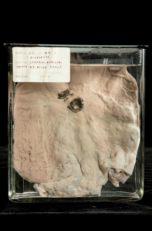 singolo reperto antropologico, preparato anatomico (morfologia alterata per patologia) (XIX-XX)