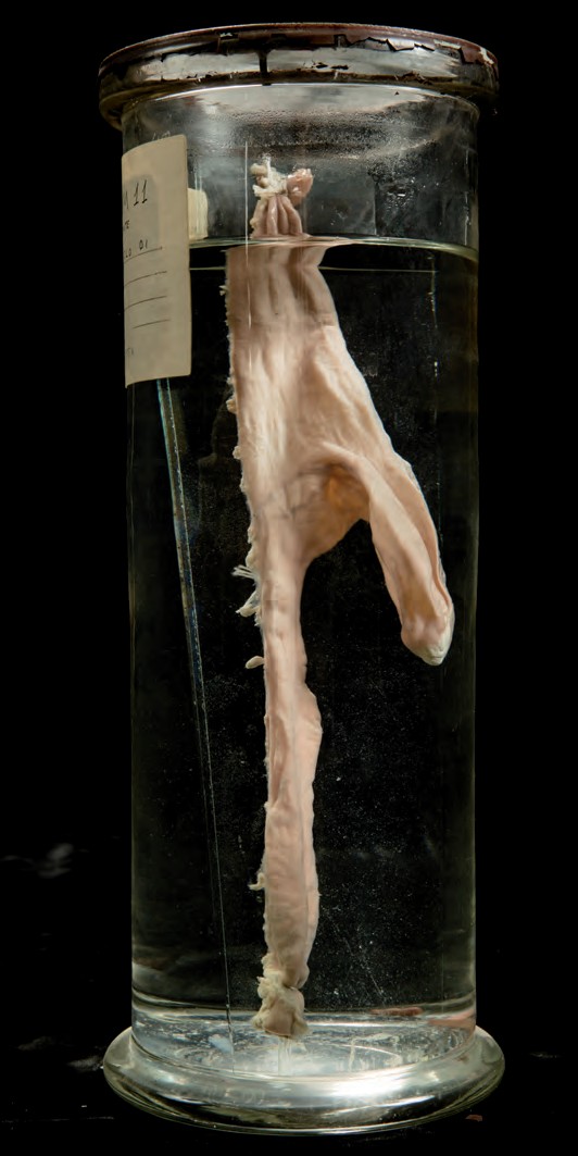 singolo reperto antropologico, preparato anatomico (morfologia alterata per patologia) (XIX-XX)