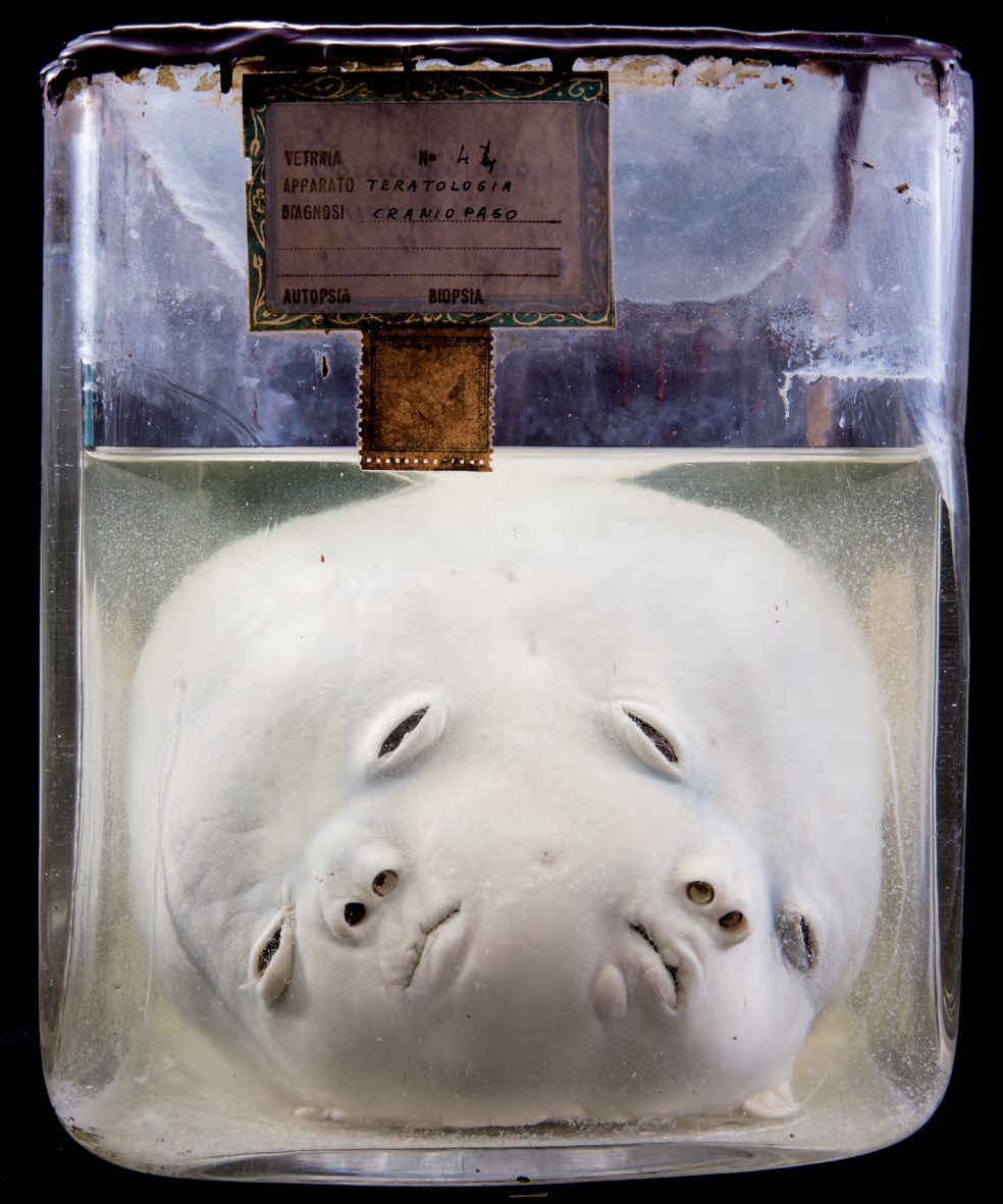 singolo reperto antropologico, preparato anatomico (morfologia alterata per patologia) (XIX-XX)