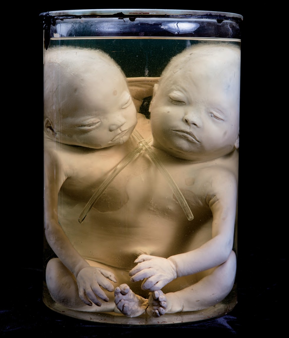 singolo reperto antropologico, preparato anatomico (morfologia alterata per patologia) (XIX-XX)