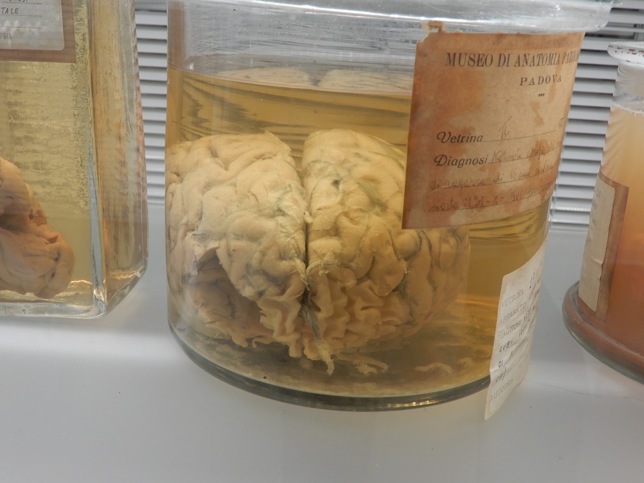 singolo reperto antropologico, preparato anatomico (morfologia alterata per patologia) (XIX-XX)