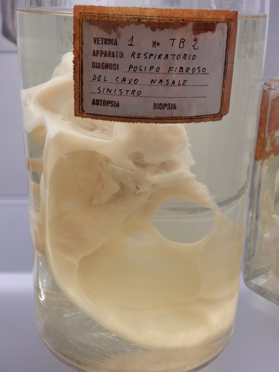 singolo reperto antropologico, preparato anatomico (morfologia alterata per patologia) (XIX-XX)