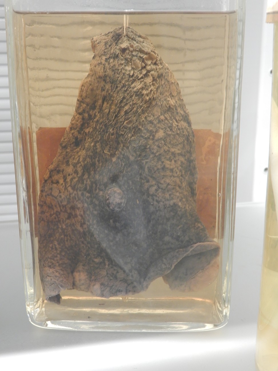 singolo reperto antropologico, preparato anatomico (morfologia alterata per patologia) (XIX-XX)