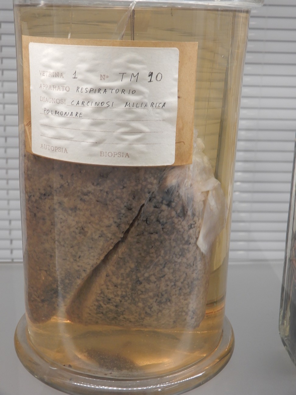 singolo reperto antropologico, preparato anatomico (morfologia alterata per patologia) (XIX-XX)