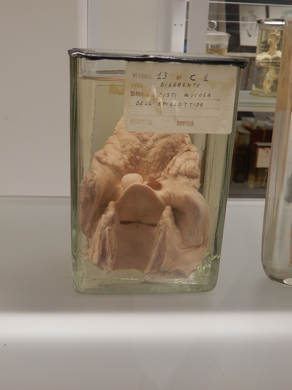 singolo reperto antropologico, preparato anatomico (morfologia alterata per patologia) (XIX-XX)