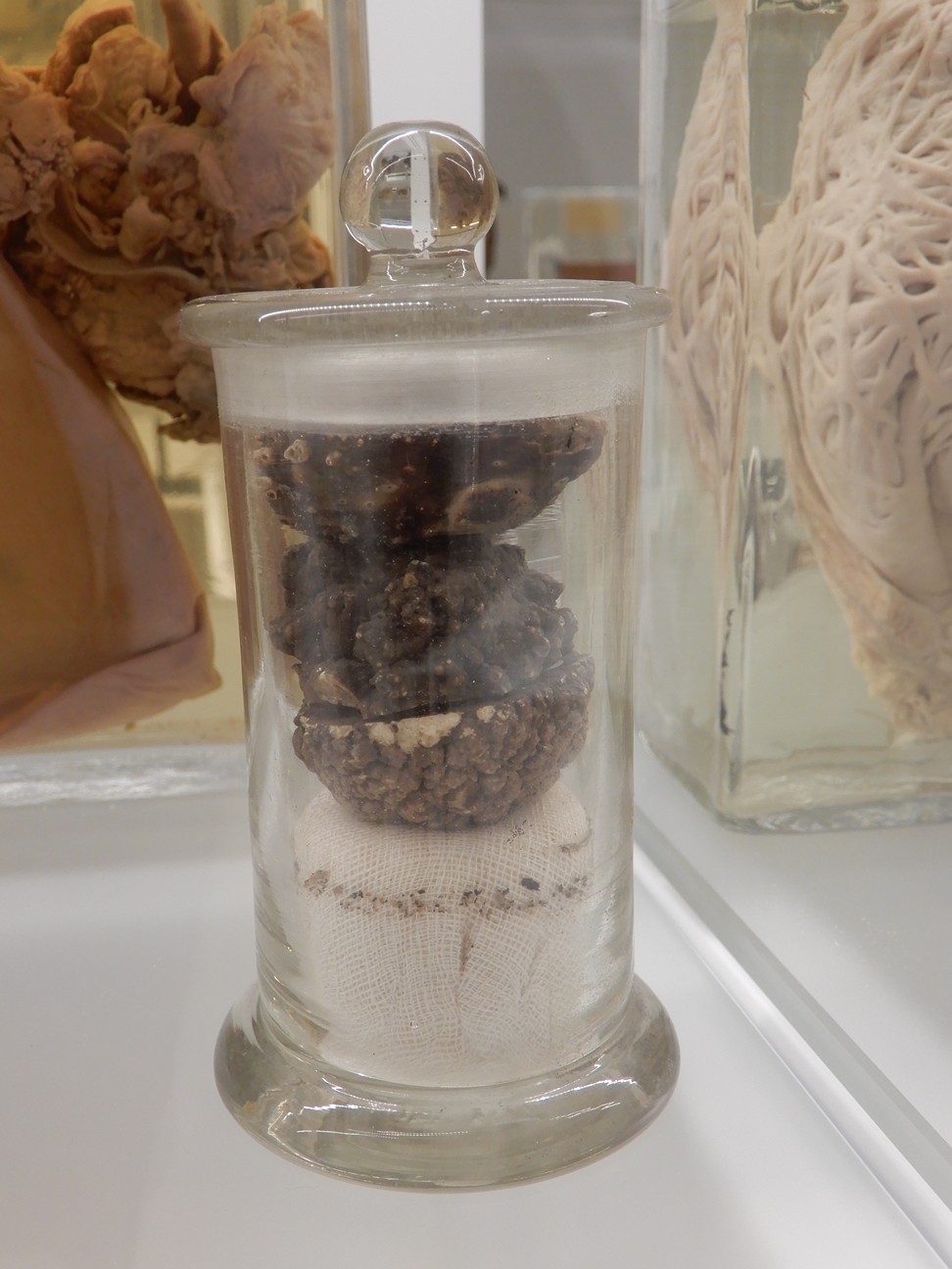 singolo reperto antropologico, preparato anatomico (morfologia alterata per patologia) (XIX-XX)