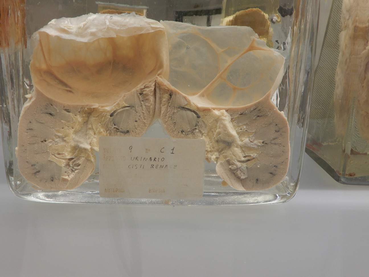 singolo reperto antropologico, preparato anatomico (morfologia alterata per patologia) (XIX-XX)