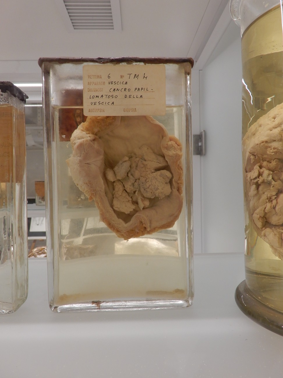 singolo reperto antropologico, preparato anatomico (morfologia alterata per patologia) (XIX-XX)