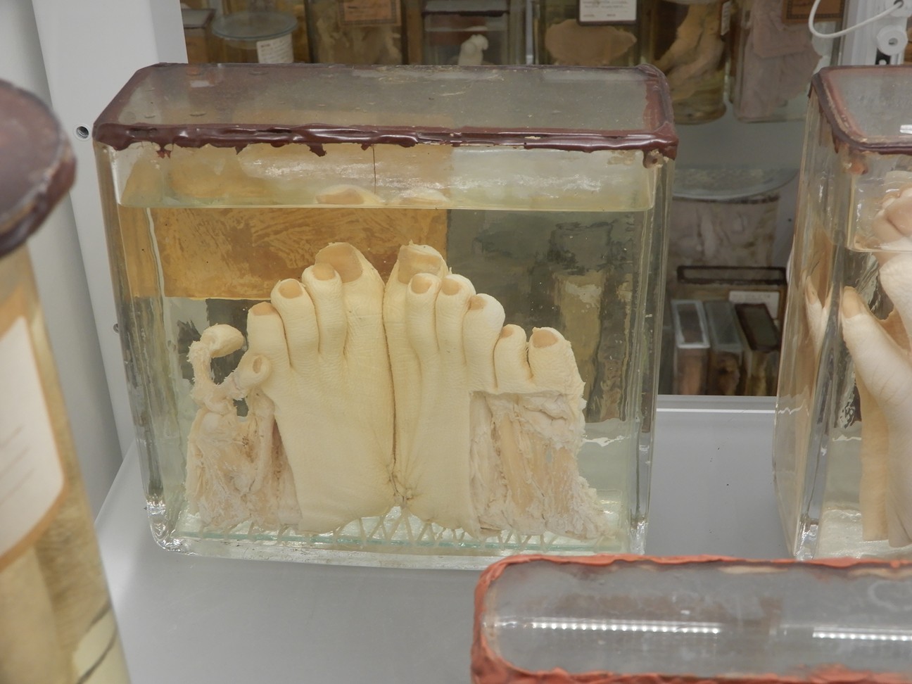 singolo reperto antropologico, preparato anatomico (morfologia alterata per patologia) (XIX-XX)