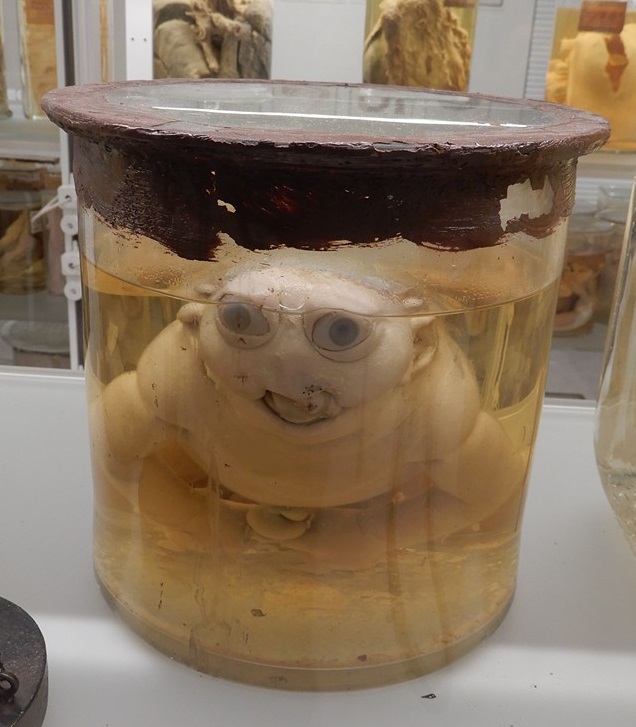 singolo reperto antropologico, preparato anatomico (morfologia alterata per patologia) (XIX-XX)