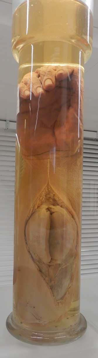 singolo reperto antropologico, preparato anatomico (morfologia alterata per patologia) (XIX-XX)