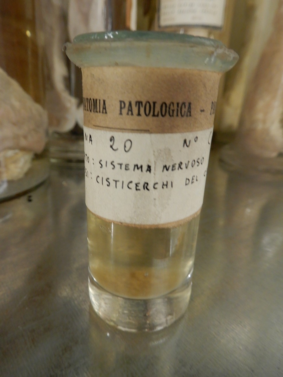 singolo reperto antropologico, preparato anatomico (morfologia alterata per patologia) (XIX-XX)