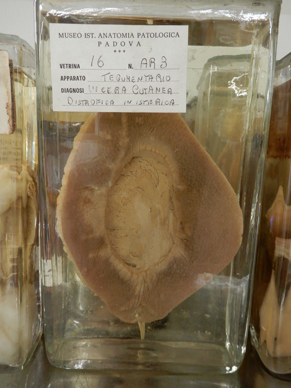 singolo reperto antropologico, preparato anatomico (morfologia alterata per patologia) (XIX-XX)