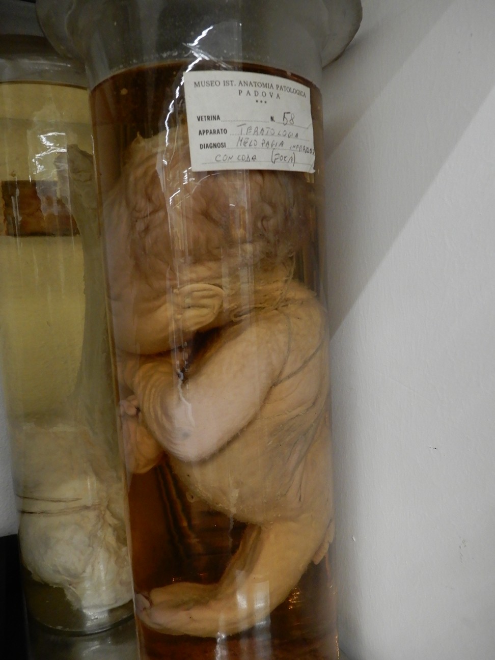 singolo reperto antropologico, preparato anatomico (morfologia alterata per patologia) (XIX-XX)