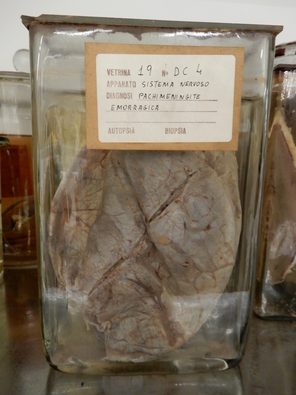 singolo reperto antropologico, preparato anatomico (morfologia alterata per patologia) (XIX-XX)