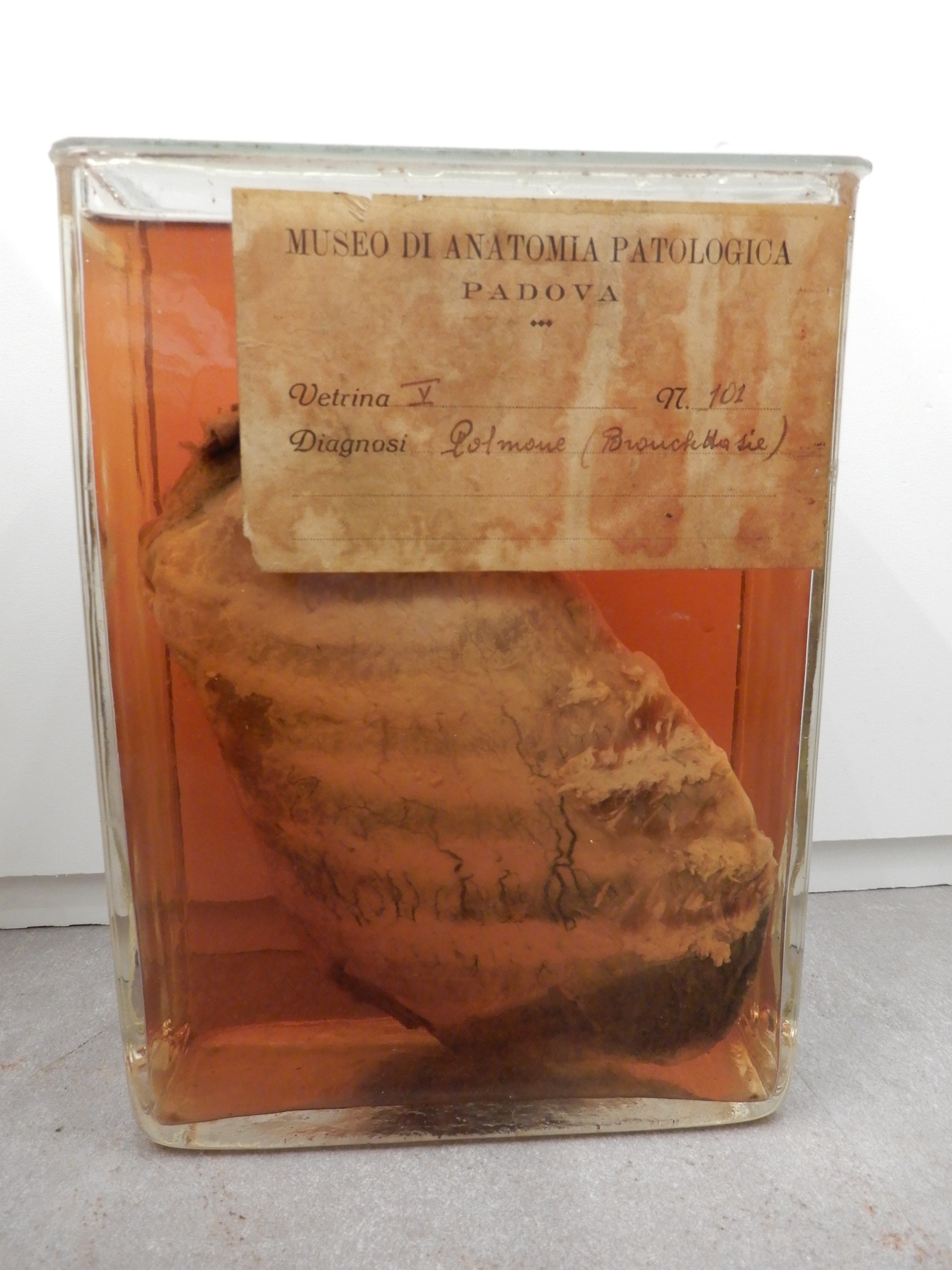 singolo reperto antropologico, preparato anatomico (morfologia alterata per patologia) (XIX-XX)