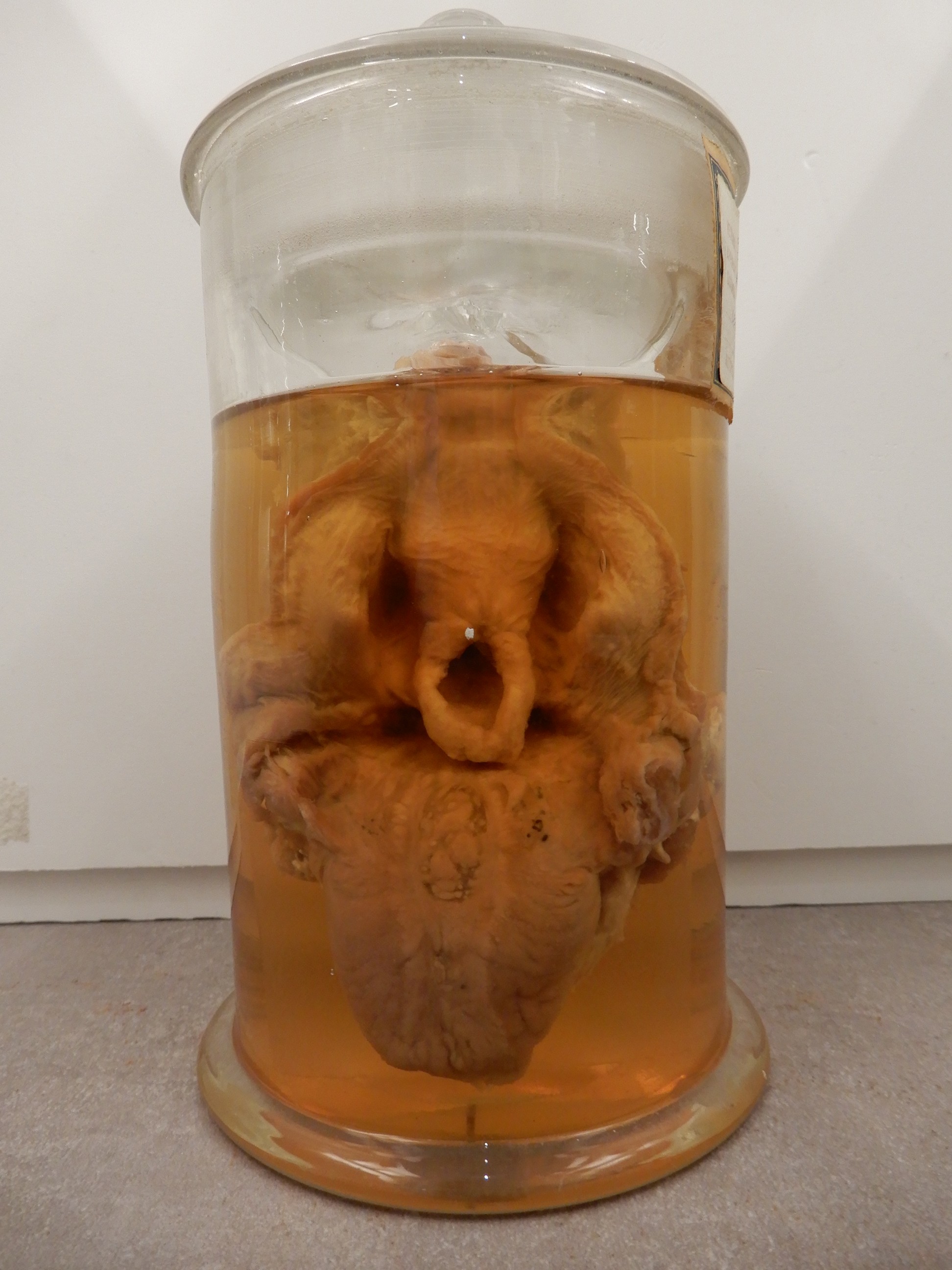 singolo reperto antropologico, preparato anatomico (morfologia alterata per patologia) (XIX-XX)