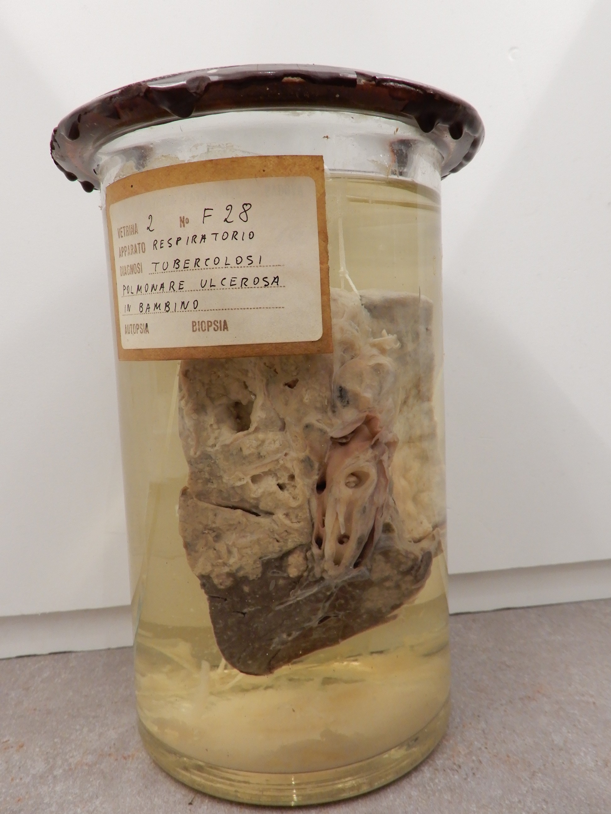 singolo reperto antropologico, preparato anatomico (morfologia alterata per patologia) (XIX-XX)