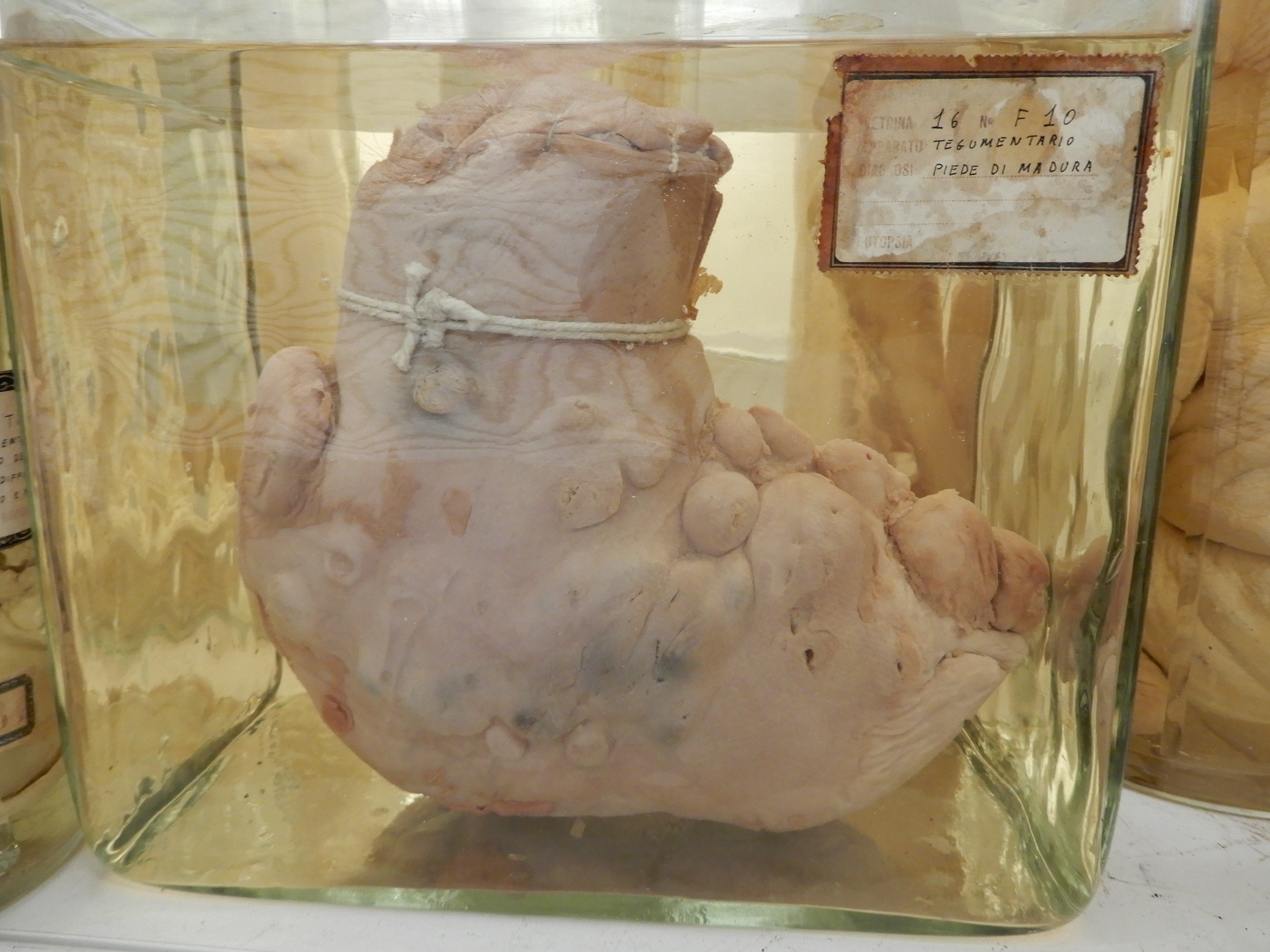 singolo reperto antropologico, preparato anatomico (morfologia alterata per patologia) (XIX-XX)