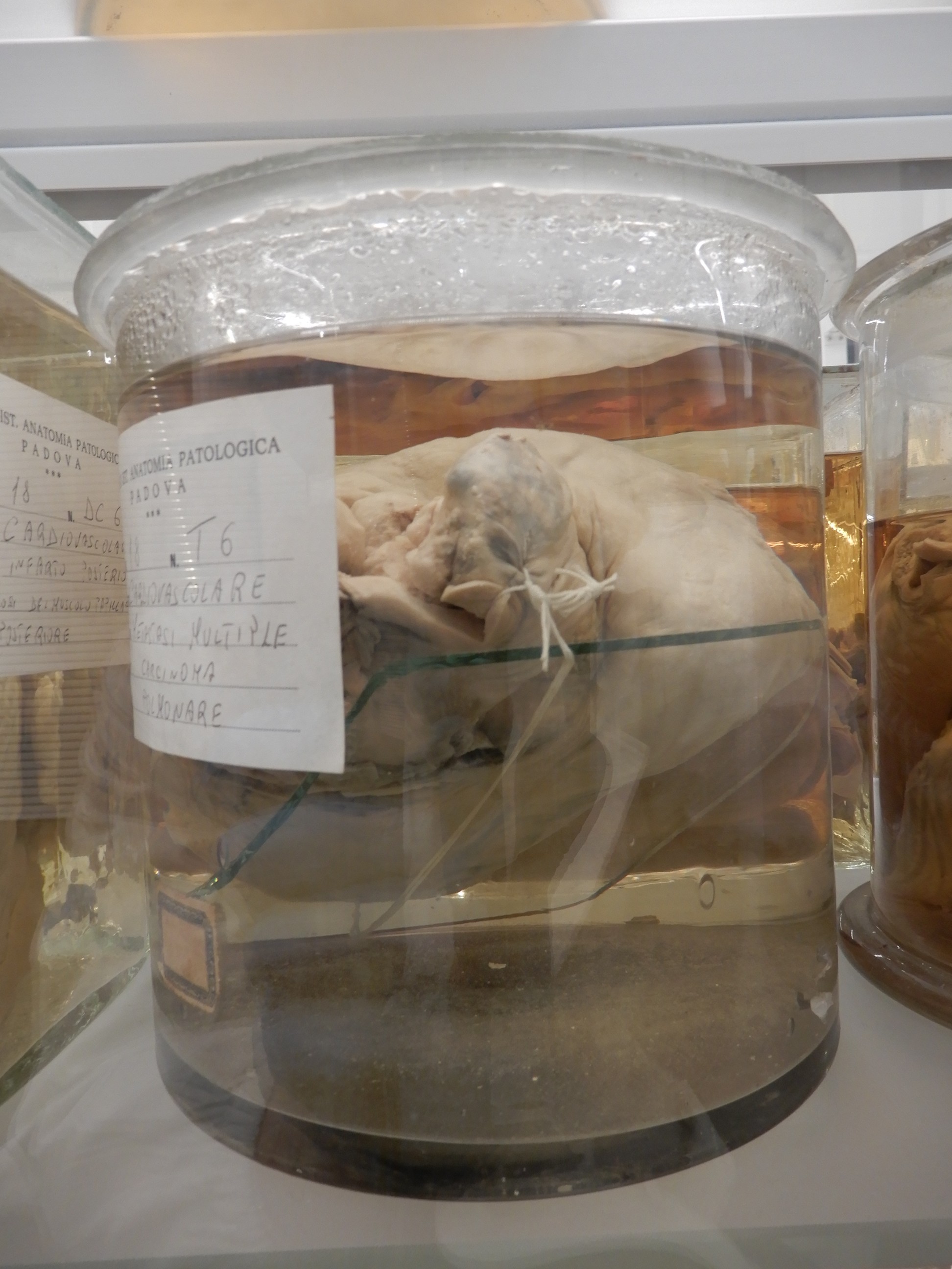 singolo reperto antropologico, preparato anatomico (morfologia alterata per patologia) (XIX-XX)