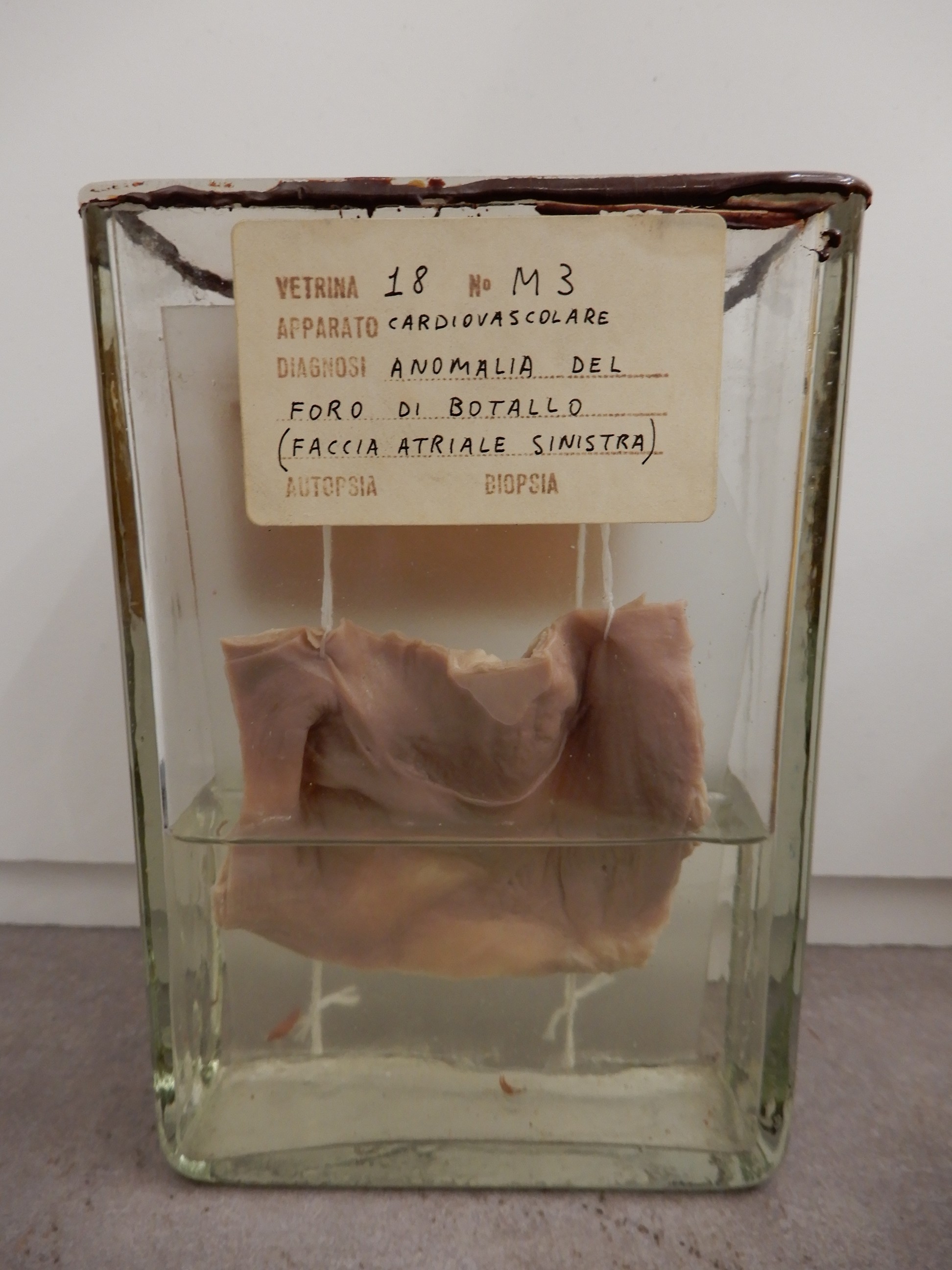 singolo reperto antropologico, preparato anatomico (morfologia alterata per patologia) (XIX-XX)