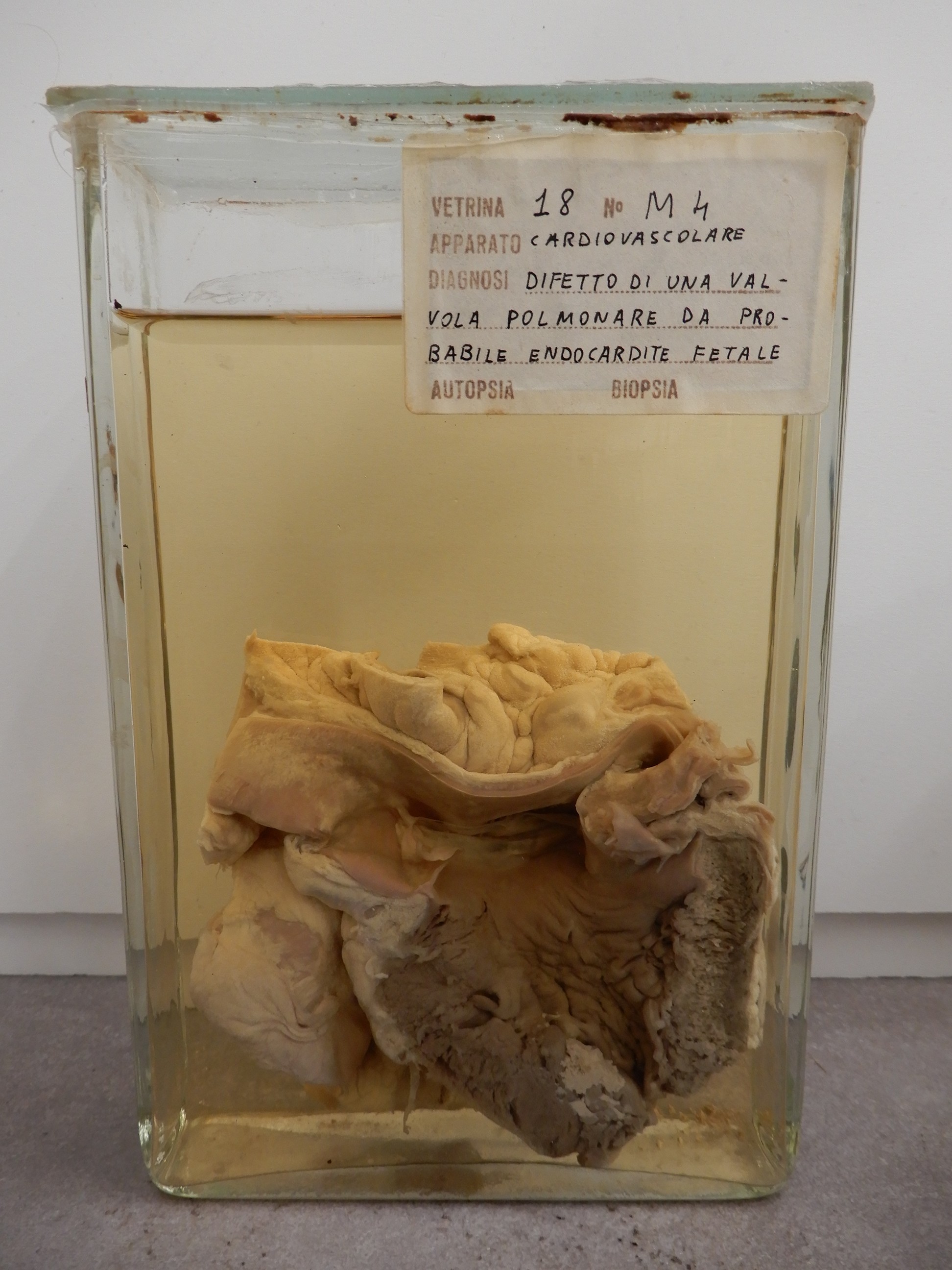 singolo reperto antropologico, preparato anatomico (morfologia alterata per patologia) (XIX-XX)