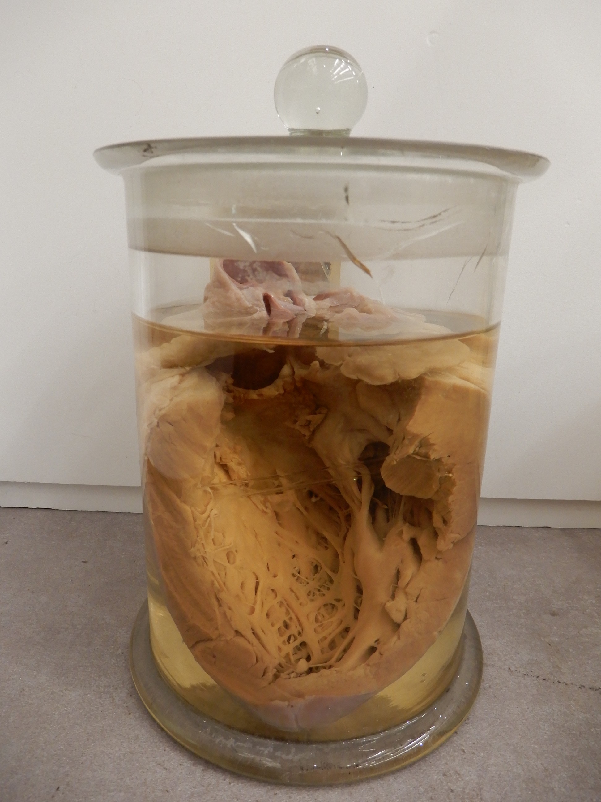 singolo reperto antropologico, preparato anatomico (morfologia alterata per patologia) (XIX-XX)