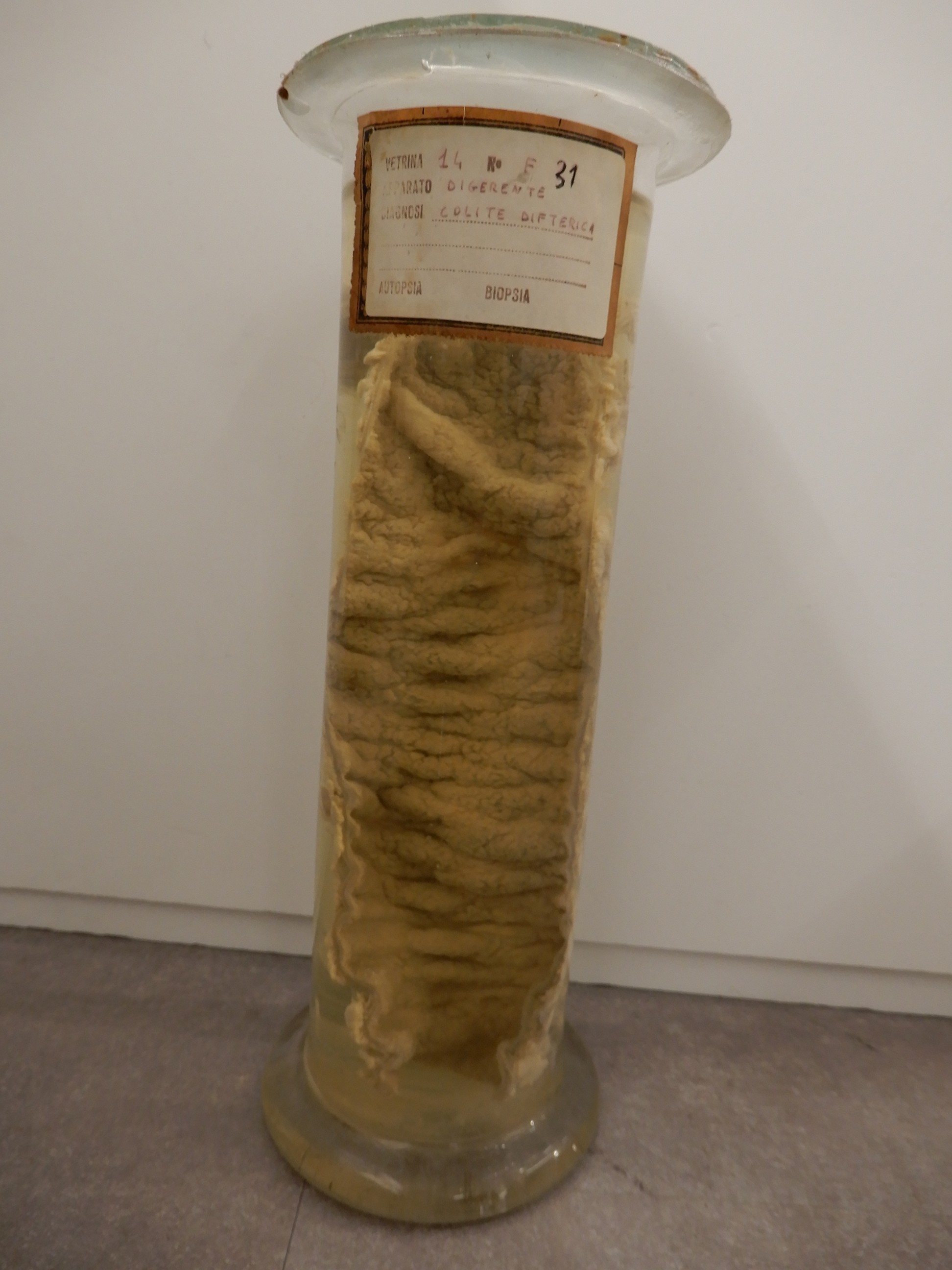 singolo reperto antropologico, preparato anatomico (morfologia alterata per patologia) (XIX-XX)