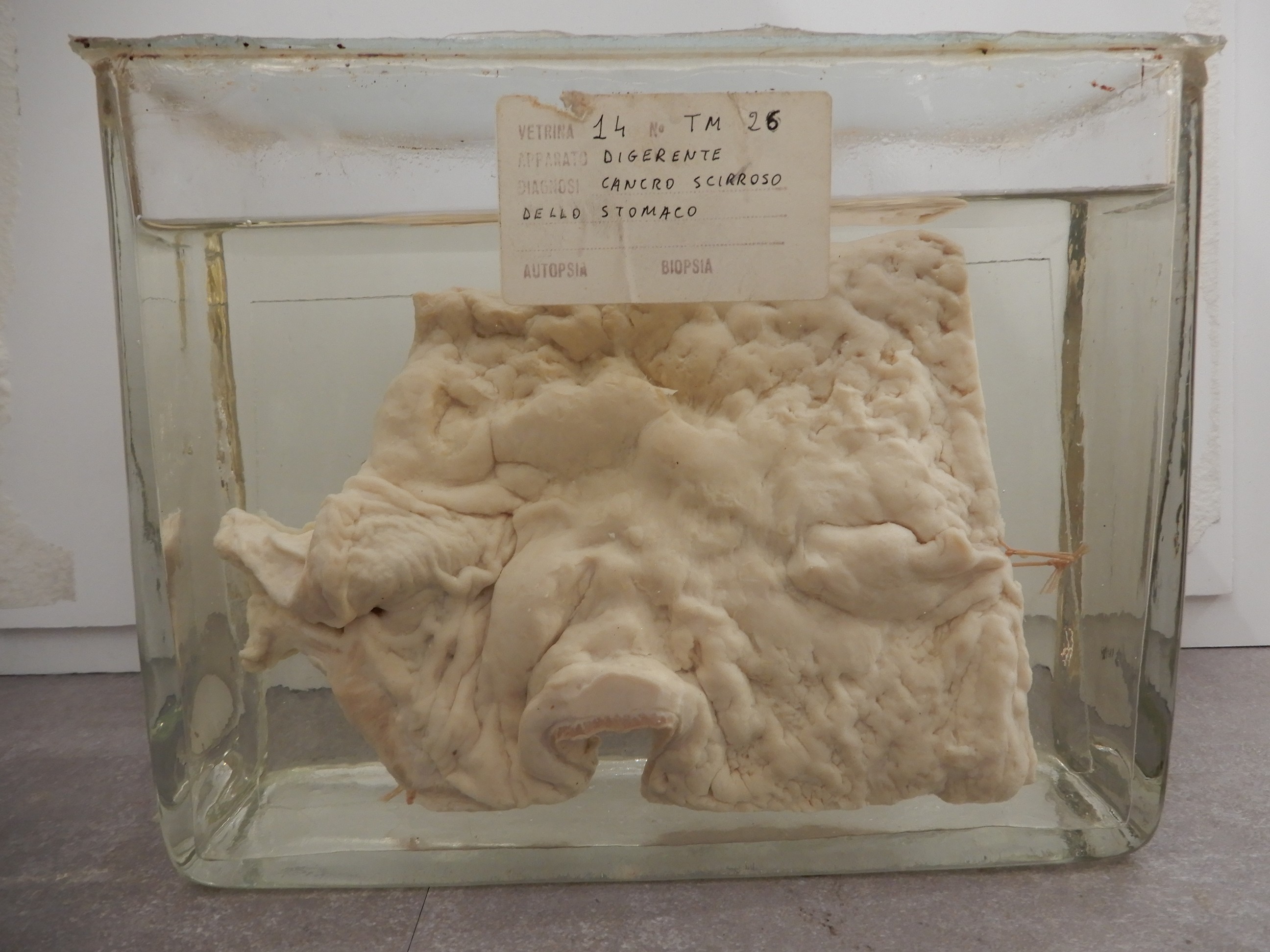 singolo reperto antropologico, preparato anatomico (morfologia alterata per patologia) (XIX-XX)