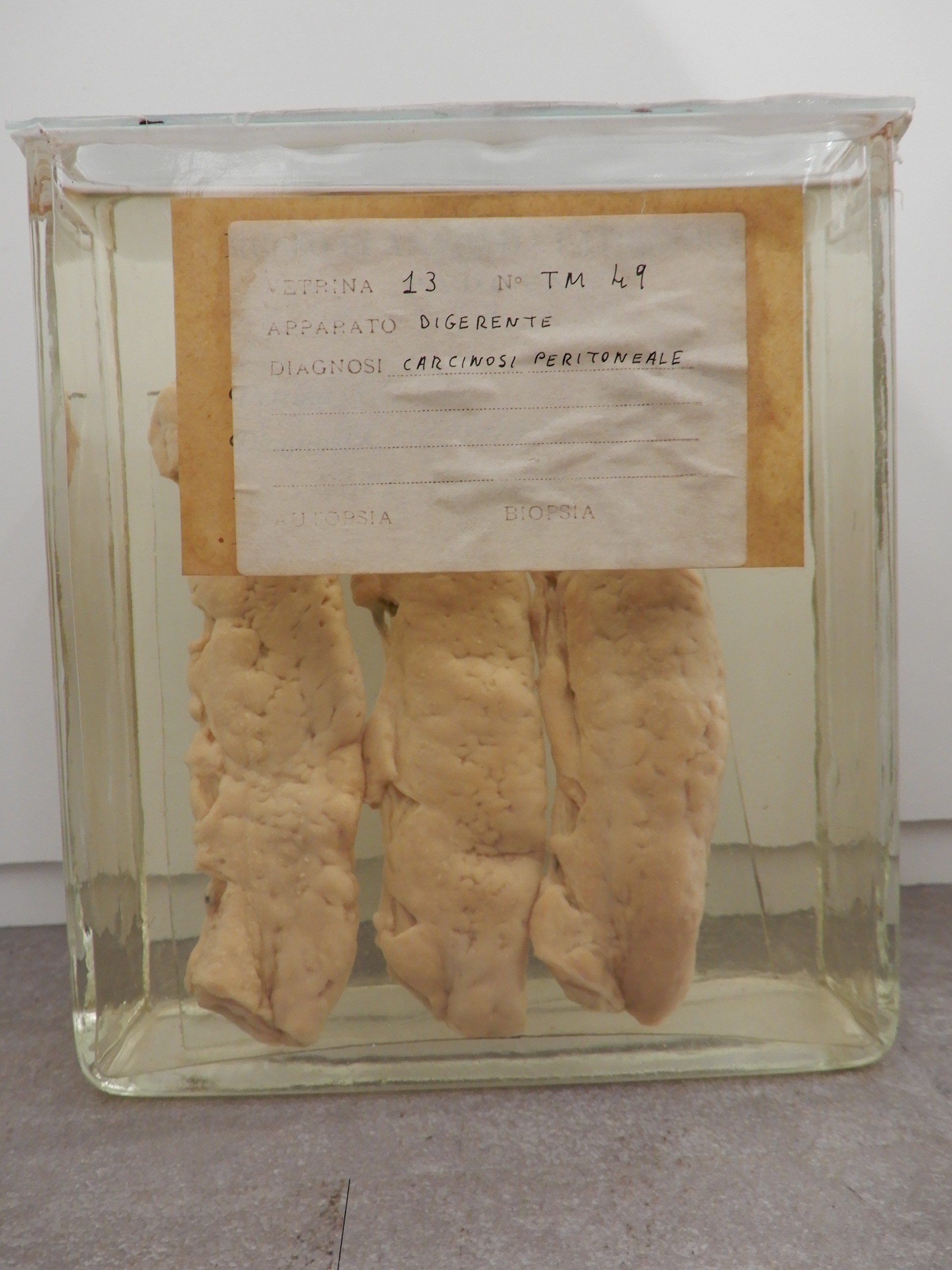 singolo reperto antropologico, preparato anatomico (morfologia alterata per patologia) (XIX-XX)