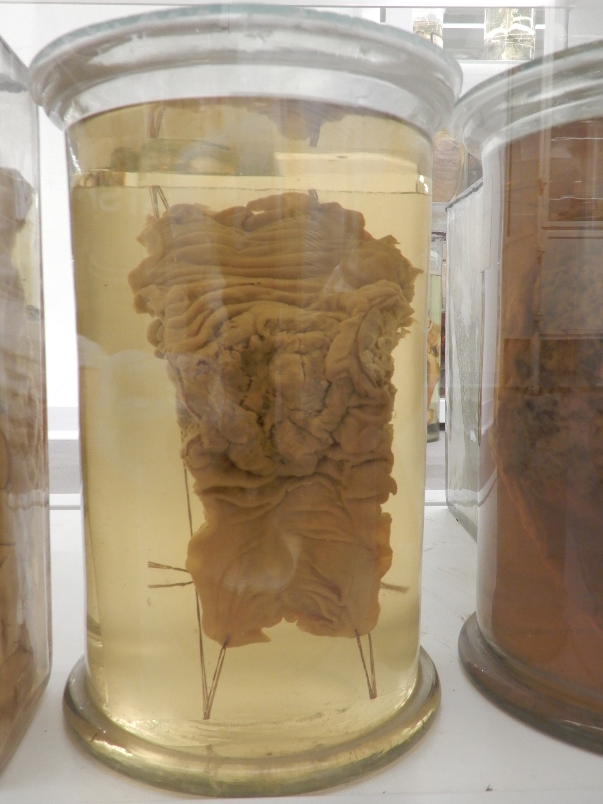 singolo reperto antropologico, preparato anatomico (morfologia alterata per patologia) (XIX-XX)