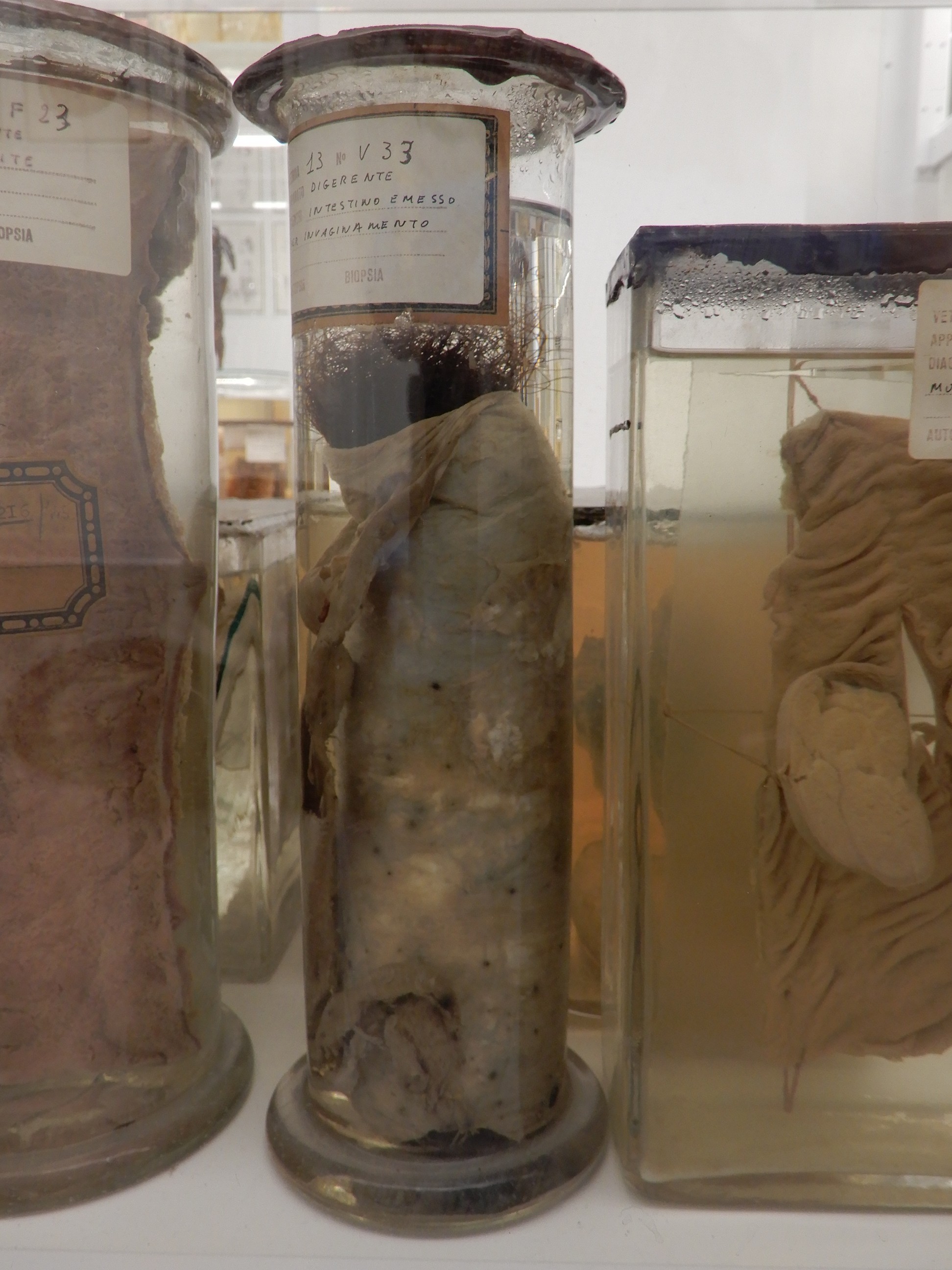 singolo reperto antropologico, preparato anatomico (morfologia alterata per patologia) (XIX-XX)