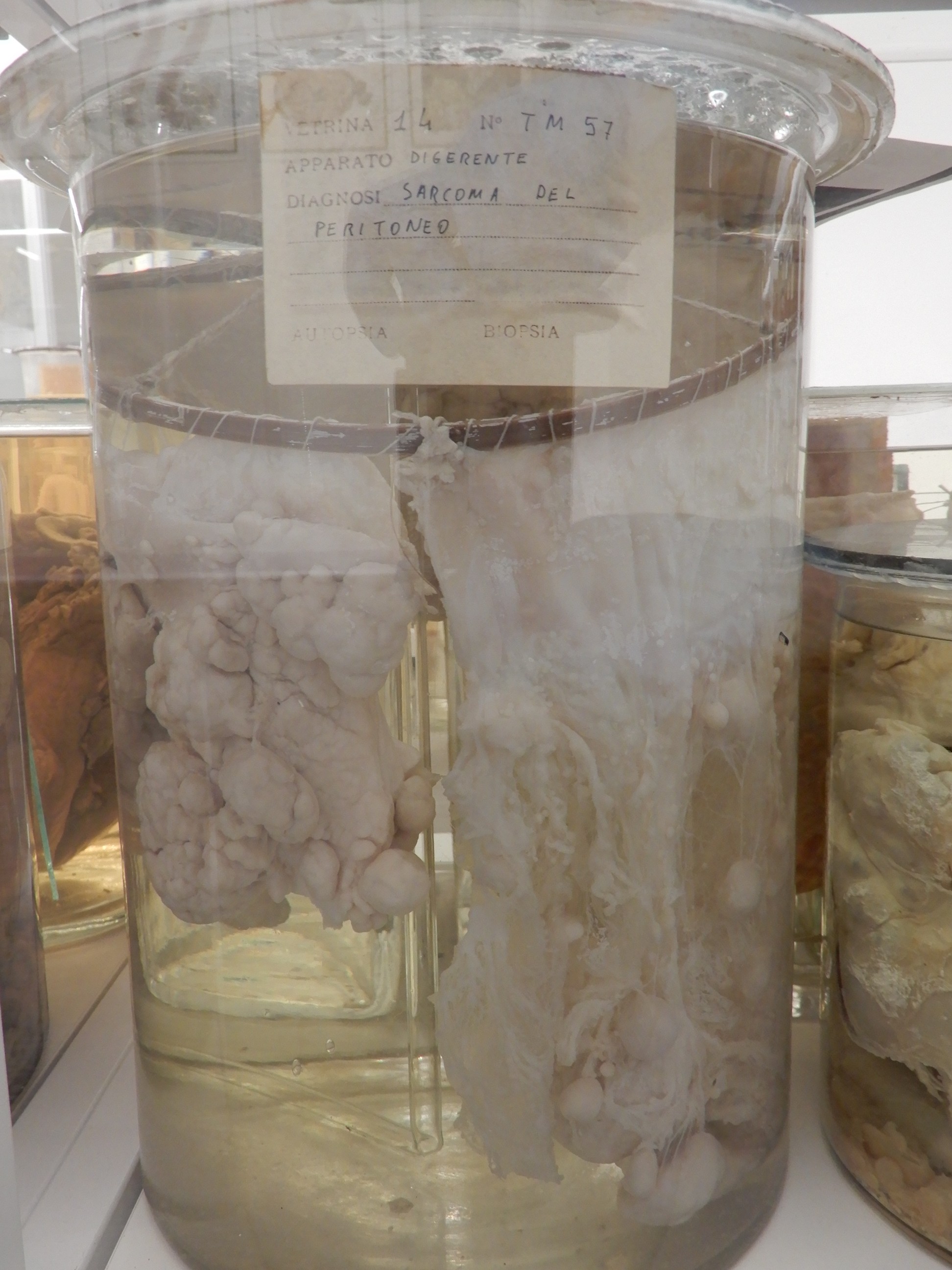 singolo reperto antropologico, preparato anatomico (morfologia alterata per patologia) (XIX-XX)