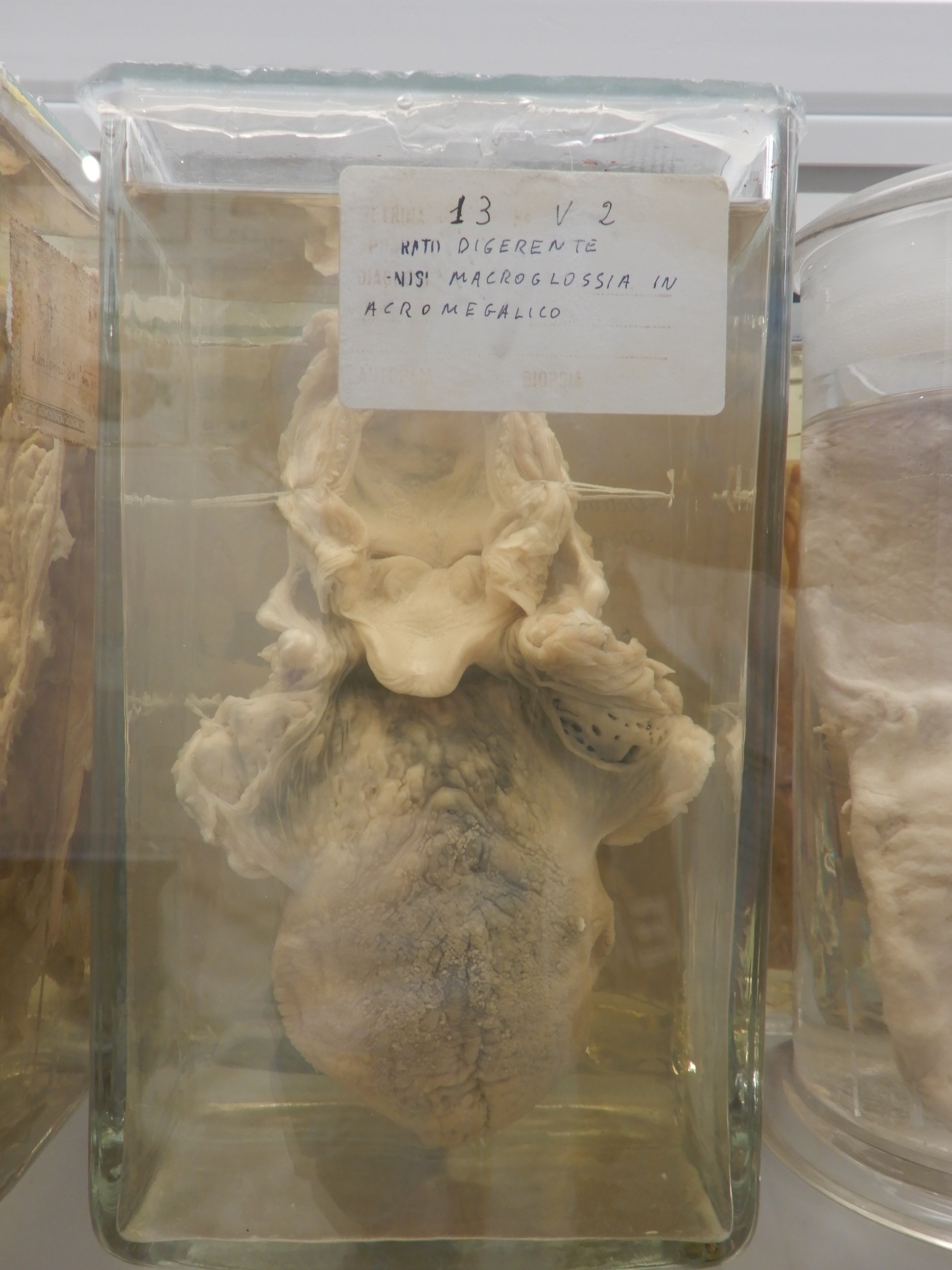 singolo reperto antropologico, preparato anatomico (morfologia alterata per patologia) (XIX-XX)