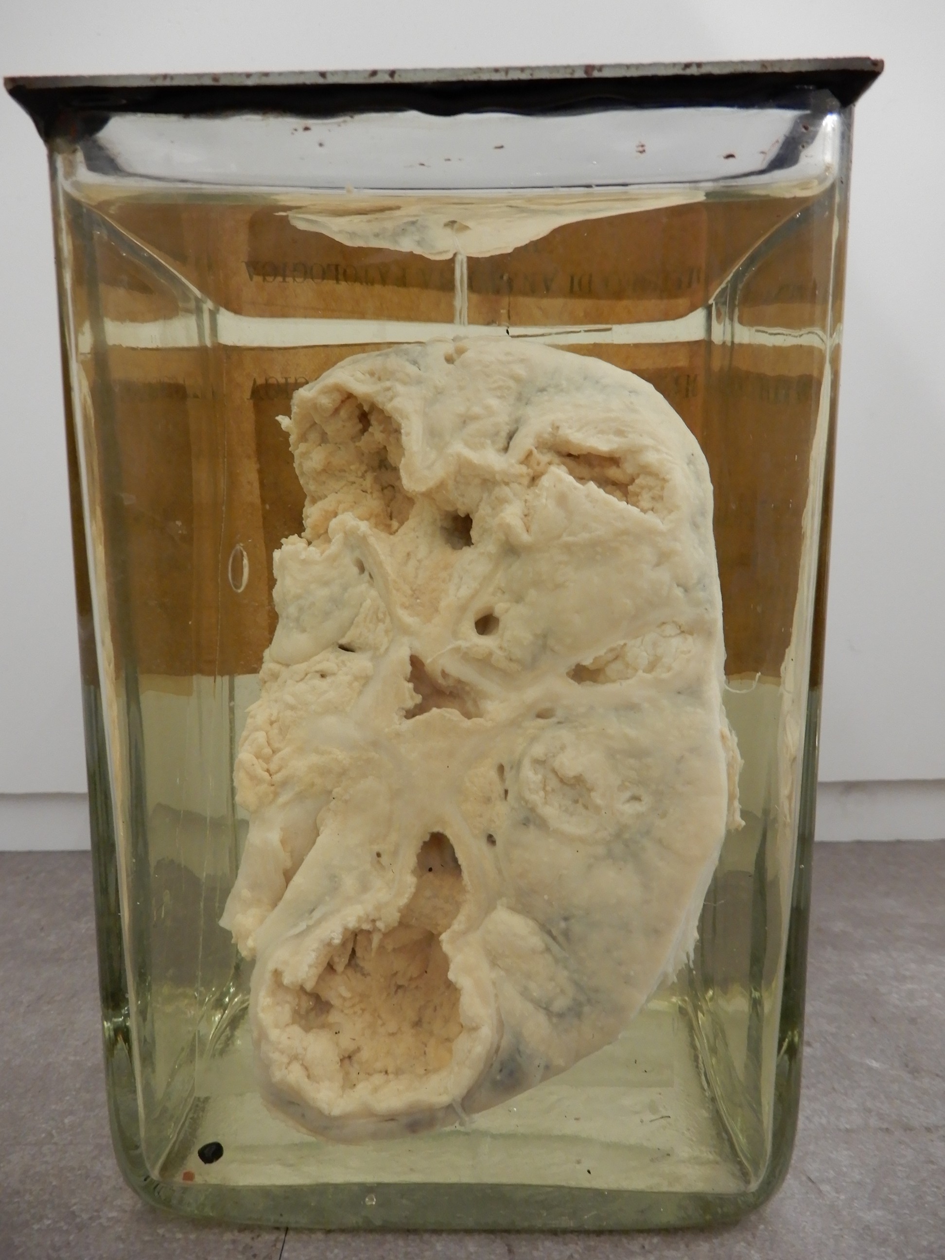 singolo reperto antropologico, preparato anatomico (morfologia alterata per patologia) (XIX-XX)