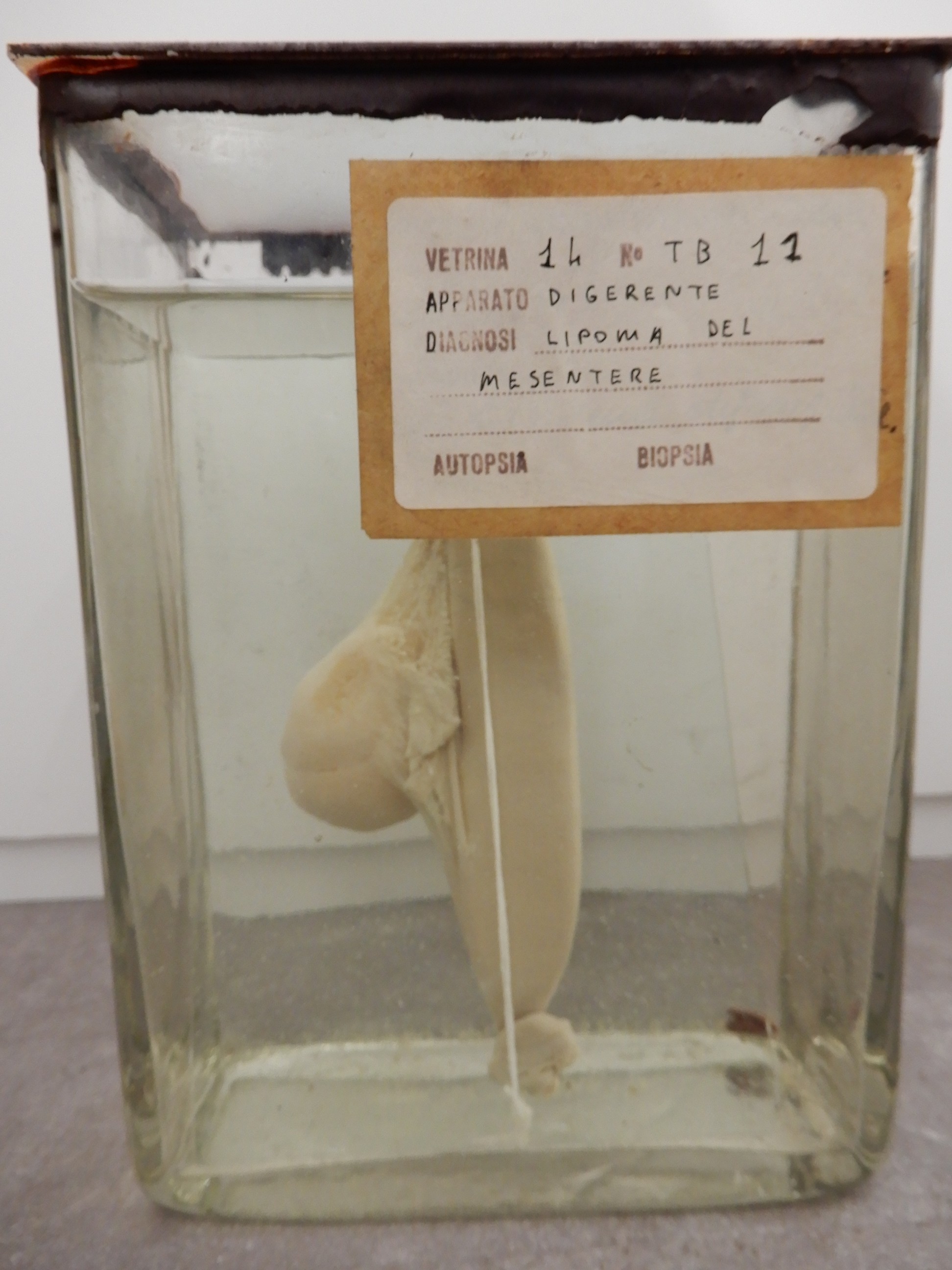 singolo reperto antropologico, preparato anatomico (morfologia alterata per patologia) (XIX-XX)