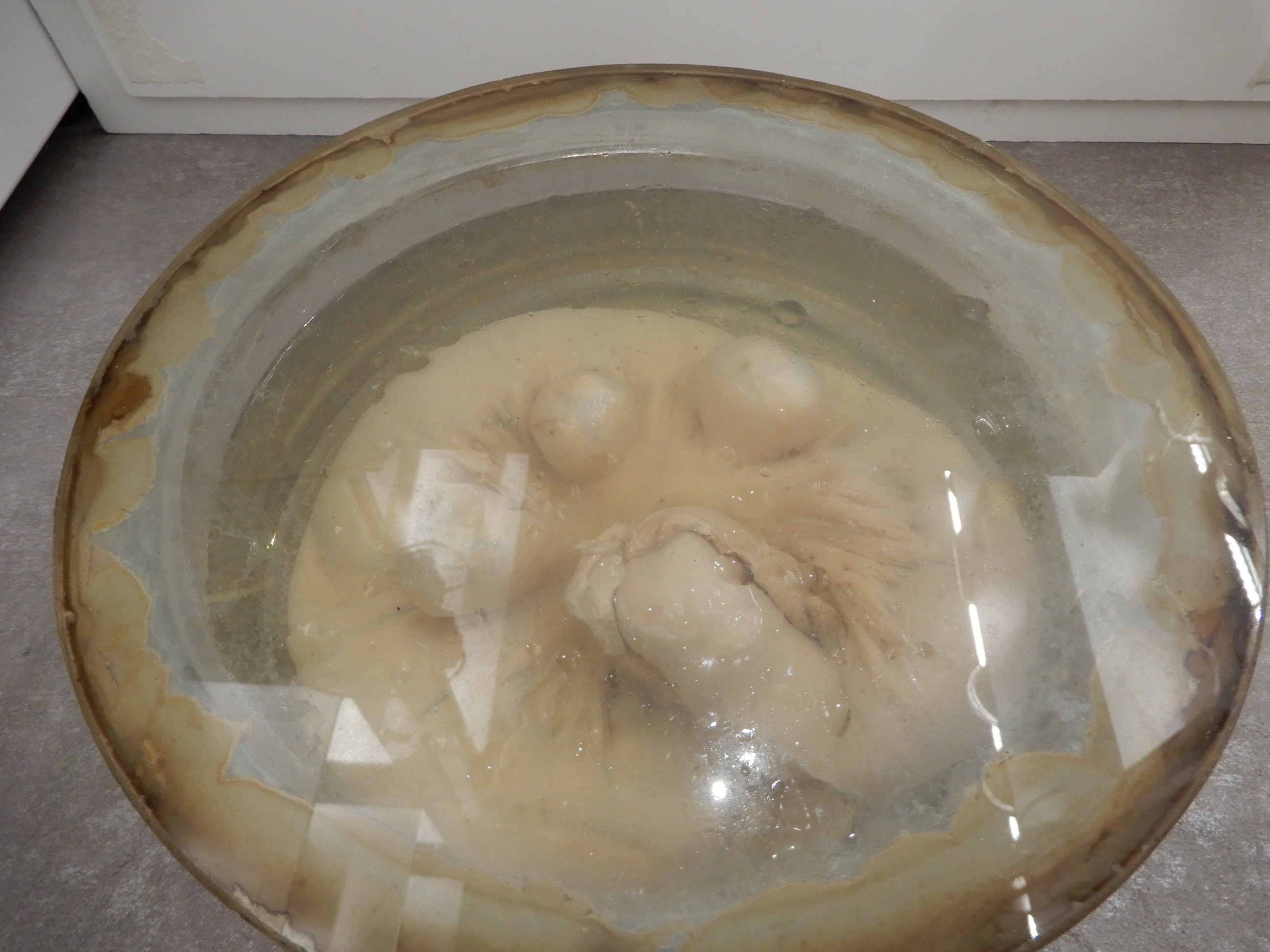 singolo reperto antropologico, preparato anatomico (morfologia alterata per patologia) (XIX-XX)