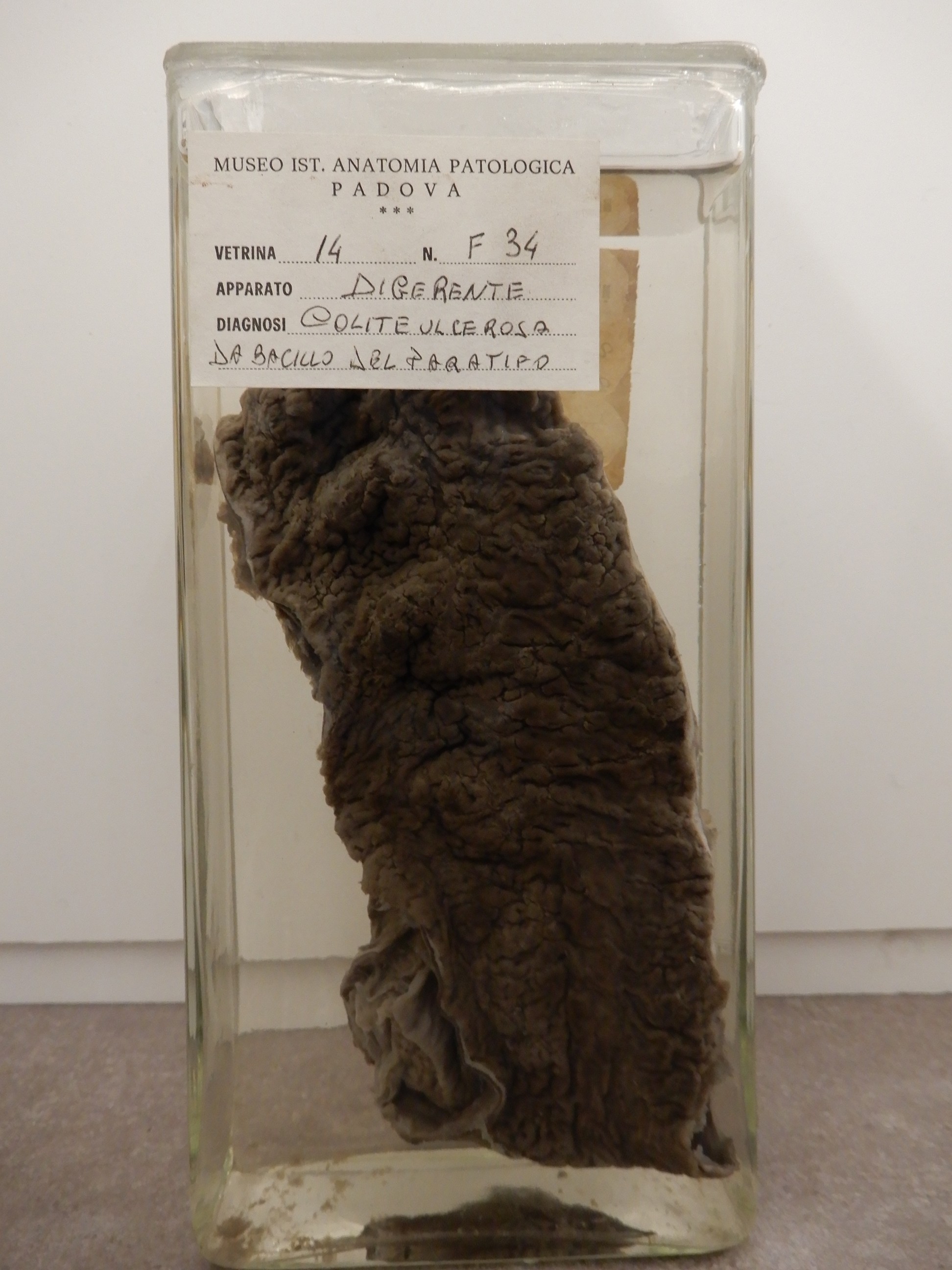 singolo reperto antropologico, preparato anatomico (morfologia alterata per patologia) (XIX-XX)