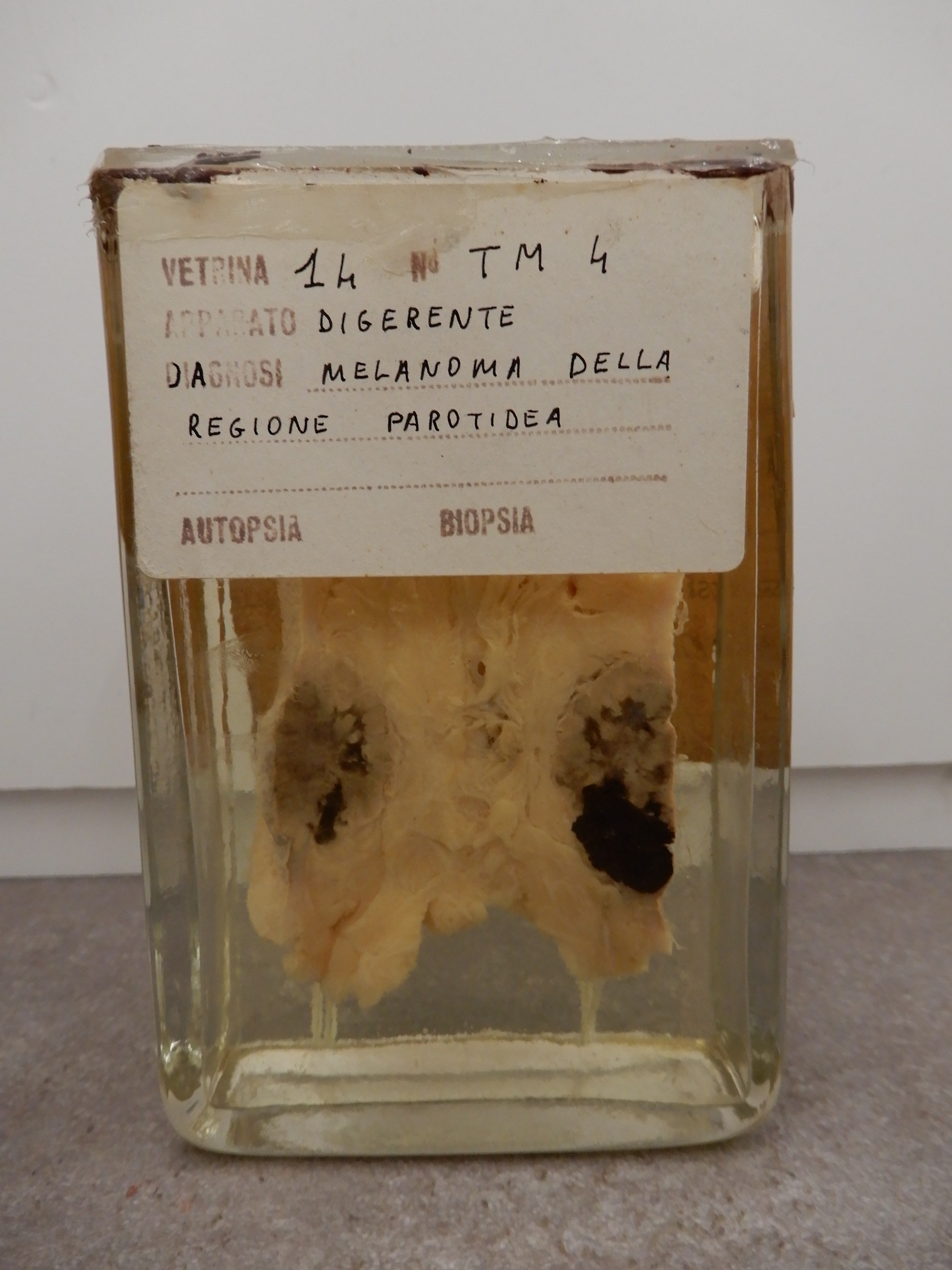 singolo reperto antropologico, preparato anatomico (morfologia alterata per patologia) (XIX-XX)