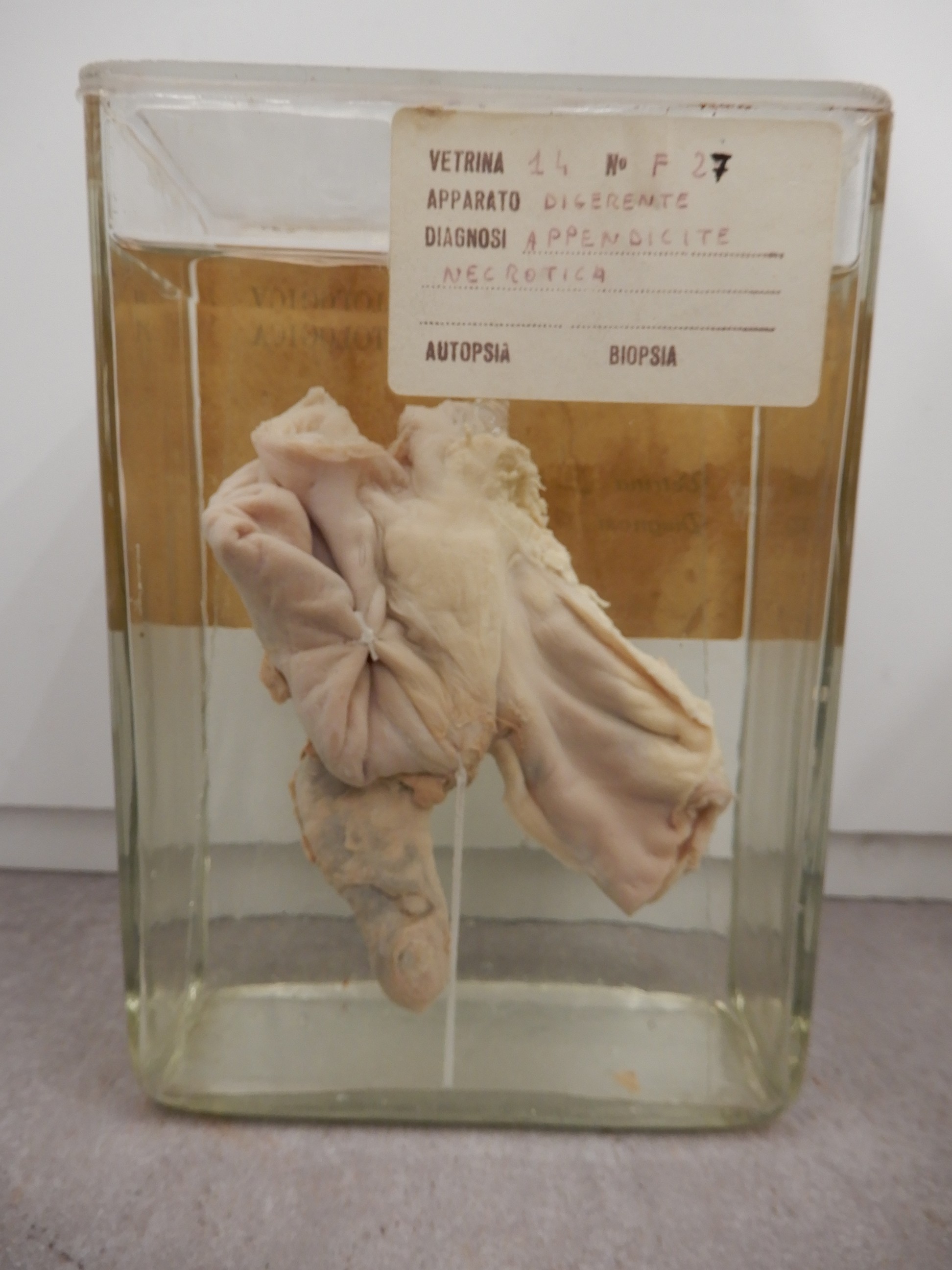 singolo reperto antropologico, preparato anatomico (morfologia alterata per patologia) (XIX-XX)